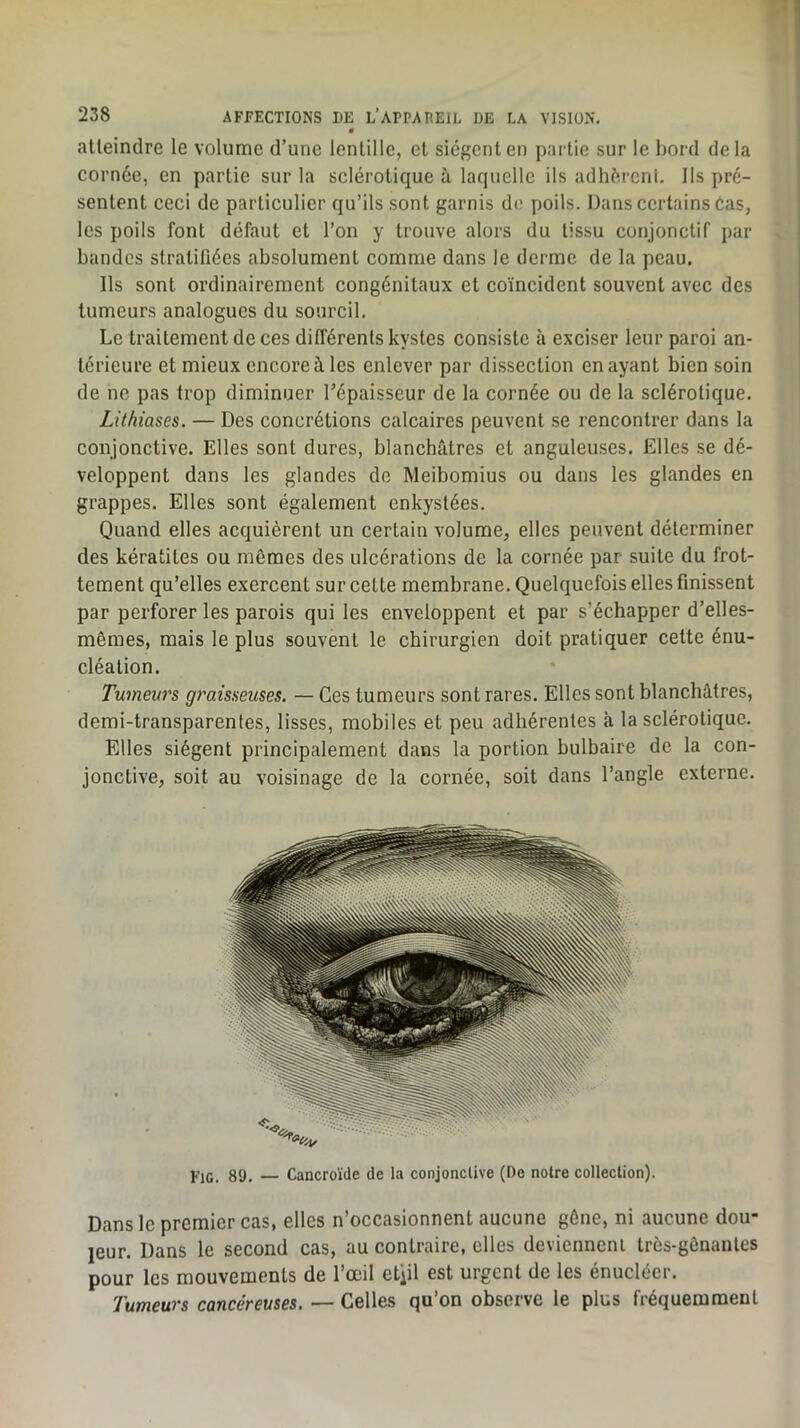 238 AFFECTIONS DE L’ArPARElL DE LA VISION. ■ alleindre le volume d’une lentille, et siègent en partie sur le bord delà cornée, en partie sur la sclérotique à laquelle ils adhércnl. Ils pré- sentent ceci de particulier qu’ils sont garnis de poils. Dans certains Cas, les poils font défaut et l’on y trouve alors du tissu conjonctif par bandes stratifiées absolument comme dans le derme de la peau. Ils sont ordinairement congénitaux et coïncident souvent avec des tumeurs analogues du sourcil. Le traitement de ces différents kystes consiste à exciser leur paroi an- térieure et mieux encore à les enlever par dissection en ayant bien soin de ne pas trop diminuer l’épaisseur de la cornée ou de la sclérotique. Lithiases. — Des concrétions calcaires peuvent se rencontrer dans la conjonctive. Elles sont dures, blanchâtres et anguleuses. Elles se dé- veloppent dans les glandes do Meibomius ou dans les glandes en grappes. Elles sont également enkystées. Quand elles acquièrent un certain volume, elles peuvent déterminer des kératites ou mêmes des ulcérations de la cornée par suite du frot- tement qu’elles exercent sur cette membrane. Quelquefois elles finissent par perforer les parois qui les enveloppent et par s’échapper d’elles- mêmes, mais le plus souvent le chirurgien doit pratiquer cette énu- cléation. Tumeurs graisseuses. — Ces tumeurs sont rares. Elles sont blanchâtres, demi-transparentes, lisses, mobiles et peu adhérentes à la sclérotique. Elles siègent principalement dans la portion bulbaire de la con- jonctive, soit au voisinage de la cornée, soit dans l’angle externe. Fie. 89. — Cancroïde de la conjonctive (De notre collection). Dans le premier cas, elles n’occasionnent aucune gêne, ni aucune dou- leur. Dans le second cas, au contraire, elles deviennent très-gênantes pour les mouvements de l’œil etiil est urgent de les énucléer. Tumeurs cancéreuses. — Celles qu’on observe le plus fréquemment