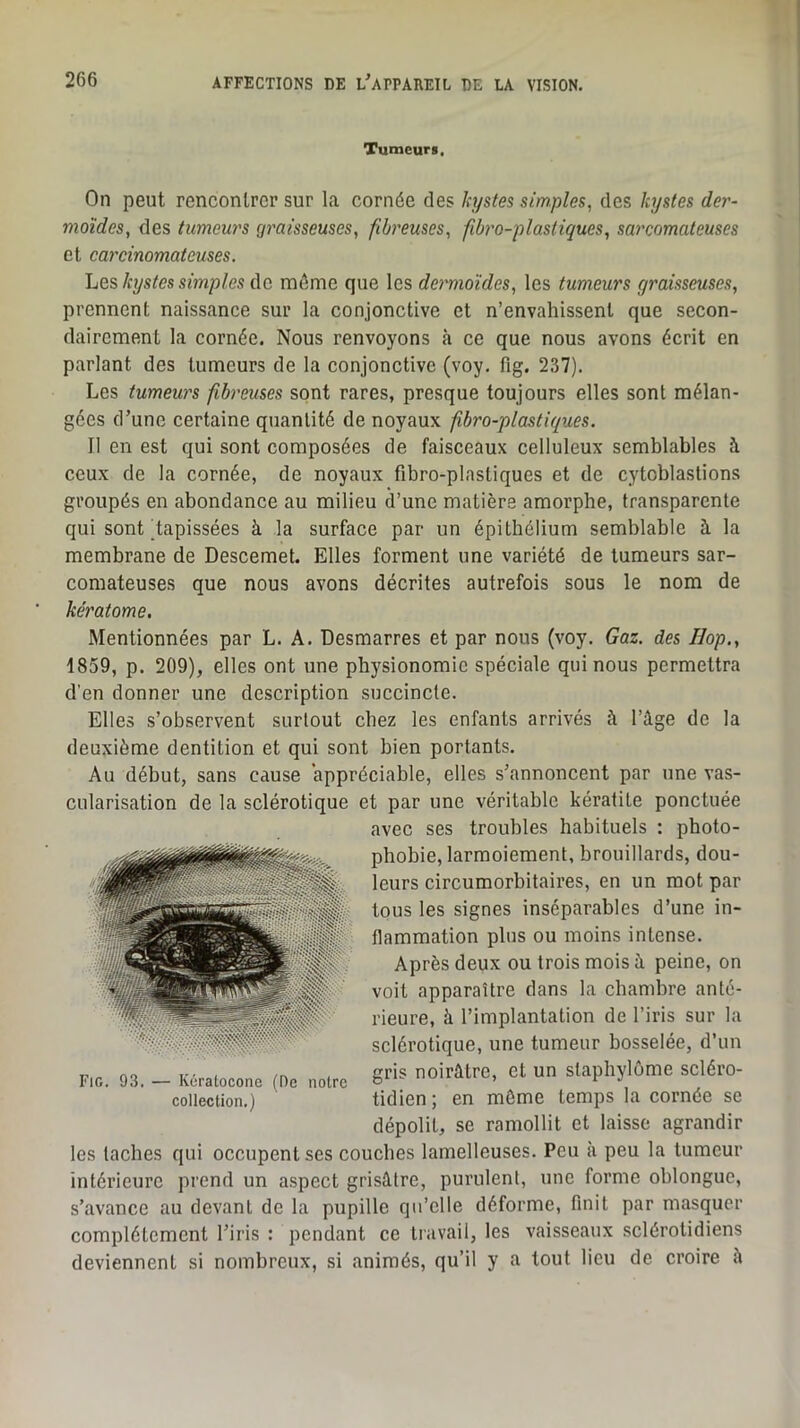 Tumeurs. On peut rencontrer sur la cornée des kystes simples, des kystes der- moides, des tumeurs graisseuses, fibreuses, fibro-plastiques, sarcomateuses et carcinomateuses. kystes simples Aq. même que les dermoïdes, les tumeurs graisseuses, prennent naissance sur la conjonctive et n’envahissent que secon- dairement la cornée. Nous renvoyons à ce que nous avons écrit en parlant des tumeurs de la conjonctive (voy. fig. 237). Les tumeurs fibreuses sont rares, presque toujours elles sont mélan- gées d’une certaine quantité de noyaux fibro-plastiques. Il en est qui sont composées de faisceaux celluleux semblables à ceux de la cornée, de noyaux fibro-plastiques et de cytoblastions groupés en abondance au milieu d’une matière amorphe, transparente qui sont ^tapissées à la surface par un épithélium semblable à la membrane de Descemet. Elles forment une variété de tumeurs sar- comateuses que nous avons décrites autrefois sous le nom de kératome. Mentionnées par L. A. Desmarres et par nous (voy. Gaz. des Hop., 1859, p. 209), elles ont une physionomie spéciale qui nous permettra d'en donner une description succincte. Elles s’observent surtout chez les enfants arrivés à l’âge de la deuxième dentition et qui sont bien portants. Au début, sans cause appréciable, elles s’annoncent par une vas- cularisation de la sclérotique et par une véritable kératite ponctuée avec ses troubles habituels : photo- phobie, larmoiement, brouillards, dou- leurs circumorbitaires, en un mot par tous les signes inséparables d’une in- flammation plus ou moins intense. Après deux ou trois mois à peine, on voit apparaître dans la chambre anté- rieure, à l’implantation de l’iris sur la sclérotique, une tumeur bosselée, d’un gris noirâtre, et un stapliylôme scléro- tidien; en môme temps la cornée se dépolit, se ramollit et laisse agrandir les taches qui occupent ses couches lamelleuses. Peu à peu la tumeur intérieure prend un aspect grisâtre, purulent, une forme oblongue, s’avance au devant de la pupille qu’elle déforme, finit par masquer complètement l’iris : pendant ce travail, les vaisseaux sclérotidiens deviennent si nombreux, si animés, qu’il y a tout lieu de croire à Fig. 93. — Kératocone (De notre collection.)