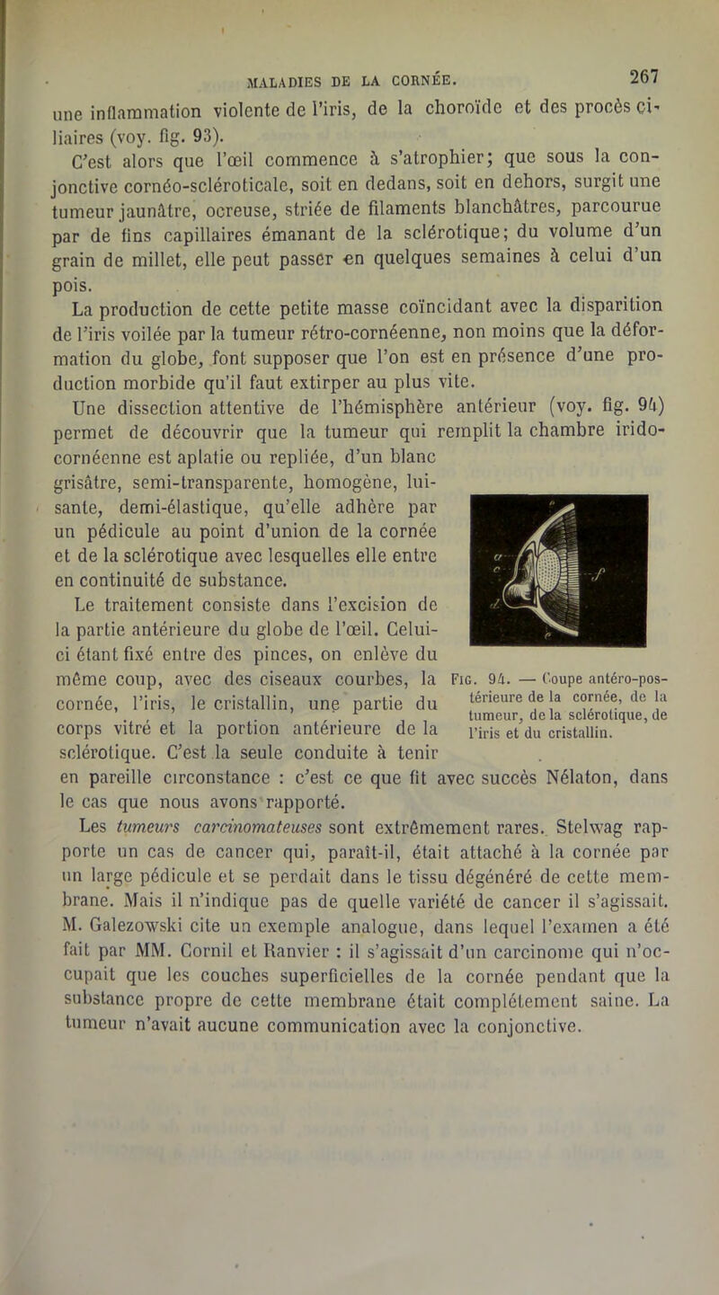 une inflammation violente de l’iris, de la choroïde et des procès ci' Maires (voy. flg. 93). C’est alors que l’œil commence h s’atrophier; que sous la con- jonctive cornéo-scléroticale, soit en dedans, soit en dehors, surgit une tumeur jaunâtre, ocreuse, striée de filaments blanchâtres, parcourue par de fins capillaires émanant de la sclérotique; du volume d’un grain de millet, elle peut passer en quelques semaines à celui d’un pois. La production de cette petite masse coïncidant avec la disparition de l’iris voilée par la tumeur rétro-cornéenne, non moins que la défor- mation du globe, font supposer que l’on est en présence d’une pro- duction morbide qu’il faut extirper au plus vite. Une dissection attentive de l’hémisphère antérieur (voy. fîg. 9â) permet de découvrir que la tumeur qui remplit la chambre irido- cornéenne est aplatie ou repliée, d’un blanc grisâtre, semi-transparente, homogène, lui- i santé, demi-élastique, qu’elle adhère par un pédicule au point d’union de la cornée et de la sclérotique avec lesquelles elle entre en continuité de substance. Le traitement consiste dans l’excision de la partie antérieure du globe de l’œil. Celui- ci étant fixé entre des pinces, on enlève du même coup, avec des ciseaux courbes, la Fig. 94. — Coupe antéro-pos- COrnée, l’iris, le cristallin, une partie du teneure de la cornee, de la corps vitre et la portion anterieure de la l’iris et du cristallin, sclérotique. C’est la seule conduite à tenir en pareille circonstance : c’est ce que fit avec succès Nélaton, dans le cas que nous avons rapporté. Les tumeu7'S ca7'cinomateuses sont extrêmement rares. Stelwag rap- porte un cas de cancer qui, paraît-il, était attaché à la cornée par un large pédicule et se perdait dans le tissu dégénéré de cette mem- brane. Mais il n’indique pas de quelle variété de cancer il s’agissait. M. Galezowski cite un exemple analogue, dans lequel l’exarnen a été fait par MM. Cornil et Ranvier : il s’agissait d’un carcinome qui n’oc- cupait que les couches superficielles de la cornée pendant que la substance propre de cette membrane était complètement saine. La tumeur n’avait aucune communication avec la conjonctive.