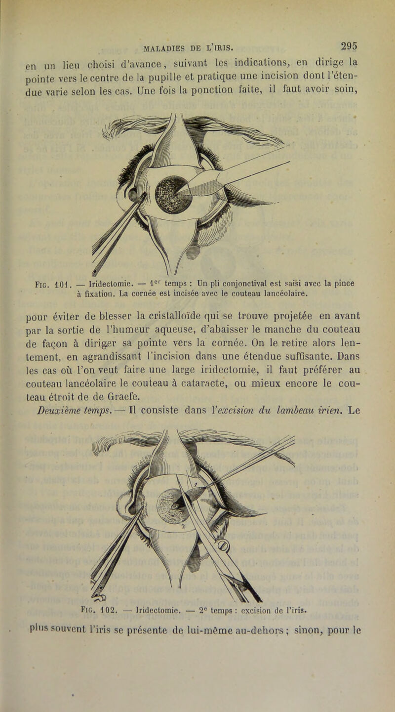 en un lien choisi d’avance, suivant les indications, en dirige la pointe vers le centre de la pupille et pratique une incision dont l’éten- due varie selon les cas. Une fois la ponction faite, il laut avoir soin. Fig. lOt. — Iridectomie. — 1®'' temps : Un pli conjonctival est saisi avec la pince à fixation. La cornée est incisée avec le couteau lancéolaire. pour éviter de blesser la cristalloïde qui se trouve projetée en avant par la sortie de l’humeur aqueuse, d’abaisser le manche du couteau de façon à dirig.er sa pointe vers la cornée. On le retire alors len- tement, en agrandissant l’incision dans une étendue suffisante. Dans les cas où l’on veut faire une large iridectomie, il faut préférer au couteau lancéolaire le couteau à cataracte, ou mieux encore le cou- teau étroit de de Graefe. Deuxième temps. — Il consiste dans Vexcision du lambeau irien. Le Fig. 102. — Iridectomie. — 2® temps: excision de l’iris, plus souvent l’iris se présente de lui-même au-dehors ; sinon, pour le