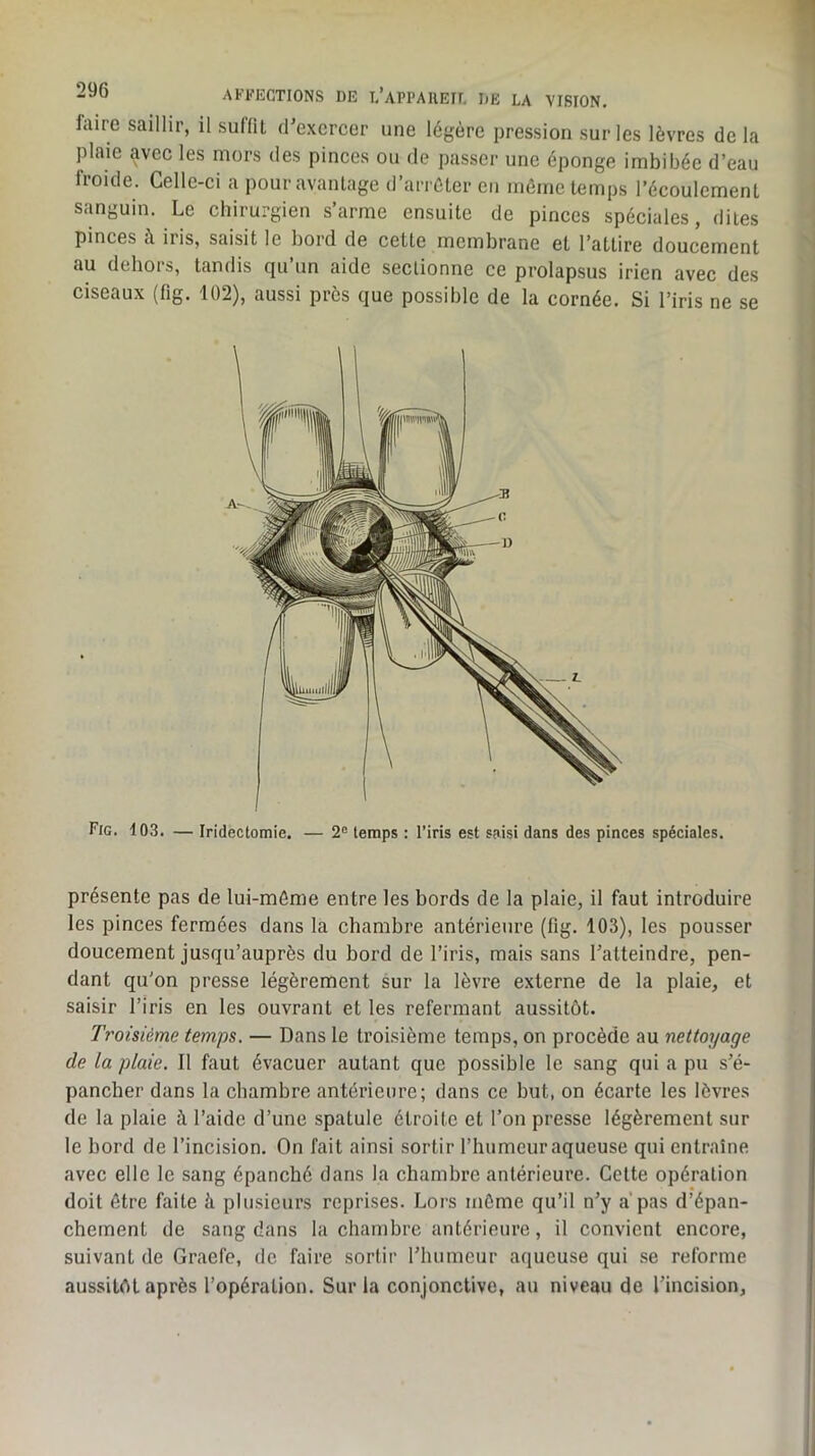 faire saillir, il suffit irexcrcer une légère pression sur les lèvres delà plaie avec les mors des pinces ou de passer une éponge imbibée d’eau froide. Celle-ci a pour avantage d’arrêter en même temps l’écoulement sanguin. Le chirurgien s’arme ensuite de pinces spéciales, dites pinces à iris, saisit le bord de celte membrane et l’attire doucement au dehors, tandis qu’un aide sectionne ce prolapsus irien avec des ciseaux (fig. 102), aussi près que possible de la cornée. Si l’iris ne se Fig. 103. — Iridectomie. — 2“ temps : l’iris est saisi dans des pinces spéciales. présente pas de lui-même entre les bords de la plaie, il faut introduire les pinces fermées dans la chambre antérieure (fig. 103), les pousser doucement jusqu’auprès du bord de l’iris, mais sans l’atteindre, pen- dant qu’on presse légèrement sur la lèvre externe de la plaie, et saisir l’iris en les ouvrant et les refermant aussitôt. Troisième temps. — Dans le troisième temps, on procède au nettoyage de la plaie. Il faut évacuer autant que possible le sang qui a pu s’é- pancher dans la chambre antérieure; dans ce but, on écarte les lèvres de la plaie à l’aide d’une spatule étroite et l’on presse légèrement sur le bord de l’incision. On fait ainsi sortir l’humeur aqueuse qui entraîne avec elle le sang épanché dans la chambre antérieure. Cette opération doit être faite à plusieurs reprises. Lors même qu’il n’y a pas d’épan- chement de sang dans la chambre antérieure, il convient encore, suivant de Graefe, de faire sortir l’humeur aqueuse qui se reforme aussitôt après l’opération. Sur la conjonctive, au niveau de l’incision.