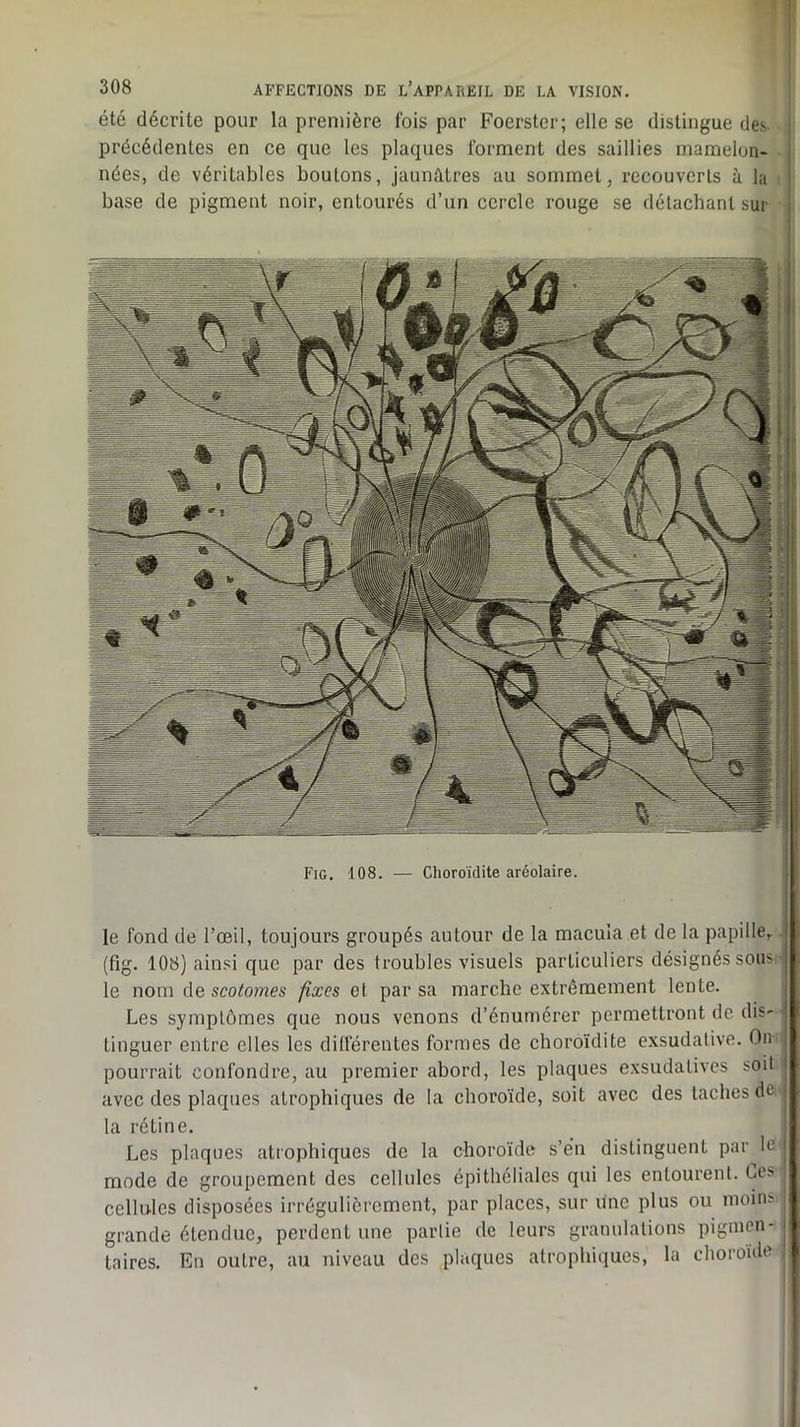 été décrite pour la première fois par Foerster; elle se distingue des précédentes en ce que les plaques forment des saillies mamelon- nées, de véritables boutons, jaundlres au sommet, recouverts à la base de pigment noir, entourés d’un cercle rouge se délacbant sur le fond de l’œil, toujours groupés autour de la macula et de la papille, (fig. 108) ainsi que par des troubles visuels particuliers désignés sous, le nom de sco/o?nes fixes cl par sa marche extrêmement lente. Les symptômes que nous venons d’énumérer permettront de dis- tinguer entre elles les dilférentes formes de cboroïdite exsudative. On pourrait confondre, au premier abord, les plaques exsudatives soit avec des plaques atrophiques de la choroïde, soit avec des taches de la rétine. Les plaques atrophiques de la choroïde s’én distinguent par le mode de groupement des cellules épithéliales qui les entourent. Le> cellules disposées irrégulièrement, par places, sur une plus ou moim grande étendue, perdent une partie de leurs granulations pigmen- taires. En outre, au niveau des plaques atrophiques, la choroïde