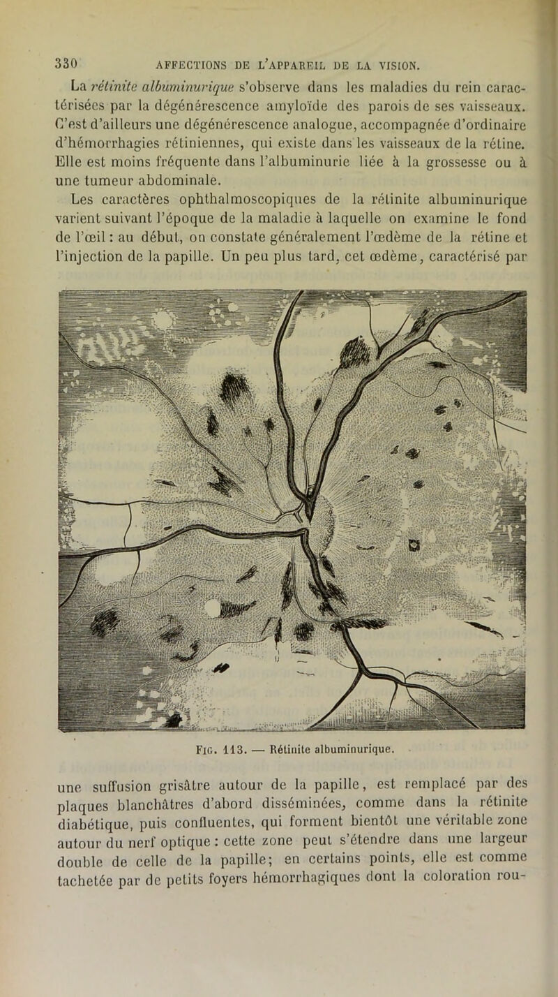 La rétinite albuminurique s’observe dans les maladies du rein carac- térisées par la dégénérescence amyloïde des parois de ses vaisseaux. C’est d’ailleurs une dégénérescence analogue, accompagnée d’ordinaire d’hémorrhagies rétiniennes, qui existe dans les vaisseaux de la rétine. Elle est moins fréquente dans l’albuminurie liée à la grossesse ou à une tumeur abdominale. Les caractères ophthalmoscopiques de la rétinite albuminurique varient suivant l’époque de la maladie à laquelle on examine le fond de l’œil : au début, on constate généralement l’œdème de la rétine et l’injection de la papille. Un peu plus tard, cet œdème, caractérisé par Fig. 113. — Rétinite albuminurique. une suffusion grisâtre autour de la papille, est remplacé par des plaques blanchâtres d’abord disséminées, comme dans la rétinite diabétique, puis confluentes, qui forment bientôt une véritable zone autour du nerf optique : cette zone peut s’étendre dans une largeur double de celle de la papille; en certains points, elle est comme tachetée par de petits foyers hémorrhagiques dont la coloration rou-