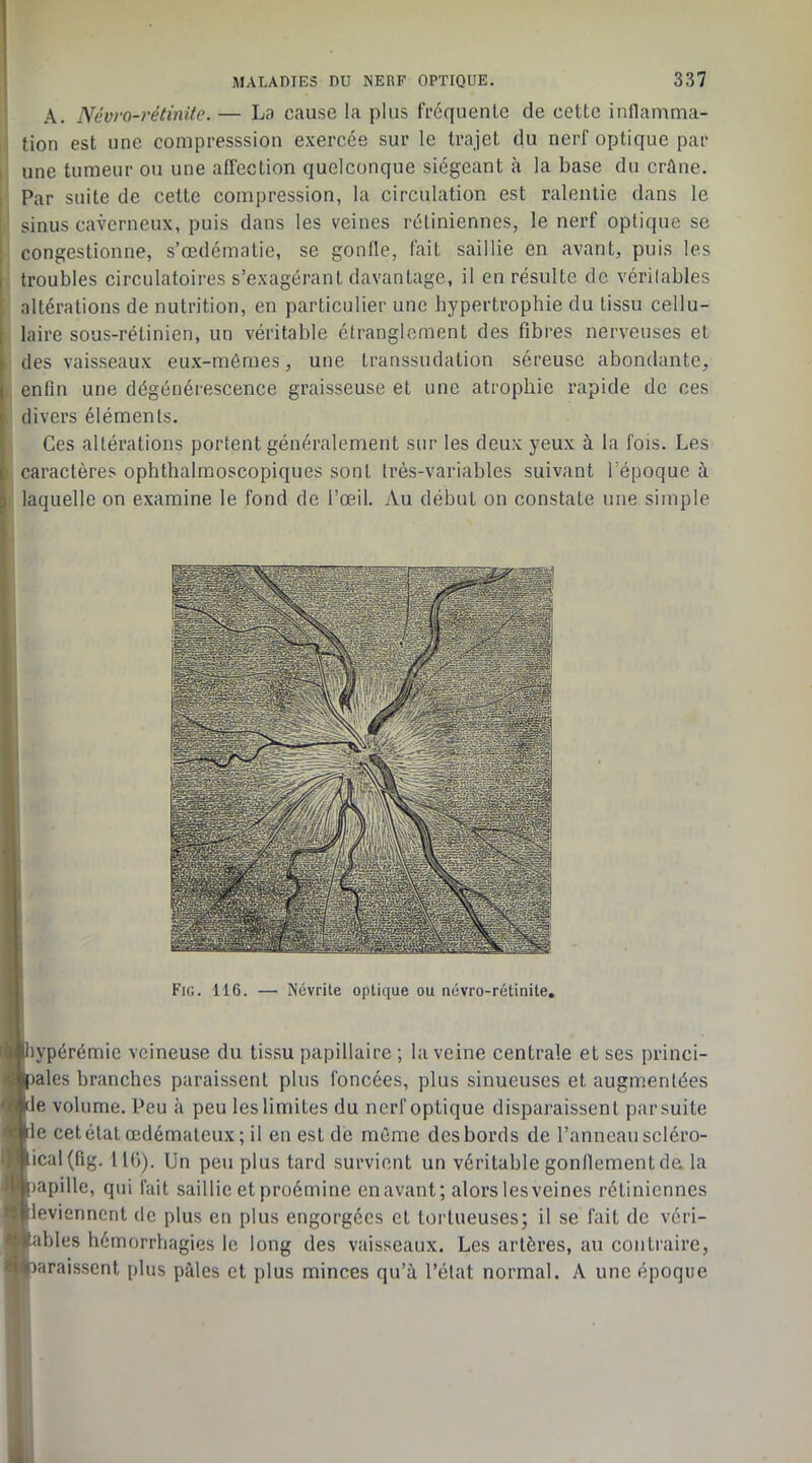 I A. Névro-rétinite. — L«t cause la plus fi’équenLc de cette inllamma- M tion est une compresssion exercée sur le trajet du nerf optique par I une tumeur ou une affection quelconque siégeant à la base du crâne. Par suite de cette compression, la circulation est ralentie dans le sinus caverneux, puis dans les veines rétiniennes, le nerf optique se congestionne, s’œdématie, se gonlle, fait saillie en avant, puis les troubles circulatoires s’exagérant davantage, il en résulte de vérilables I altérations de nutrition, en particulier une hypertrophie du tissu cellu- j laire sous-rétinien, un véritable étranglement des fibres nerveuses et . des vaisseaux eux-mômes, une transsudation séreuse abondante, : enfin une dégénérescence graisseuse et une atrophie rapide de ces I divers éléments. Ces altérations portent généralement sur les deux yeux à la fois. Les I caractères ophthalmoscopiques sont très-variables suivant l’époque à laquelle on examine le fond de l’œil. Au début on constate une simple Fig. 116. — Névrite optique ou névro-rétinite. [liypérémie veineuse du tissu papillaire ; la veine centrale et ses princi- ([lales branches paraissent plus foncées, plus sinueuses et augmentées |de volume. Peu à peu les limites du nerf optique disparaissent par suite Me cet état œdémateux ; il en est de même des bords de l’anneau scléro- lical(fig. IIO). Un peu plus tard survient un véritable gonflement de. la papille, qui fait saillie et proémine cnavant; alors les veines rétiniennes Hevicnnent de plus en plus engorgées et tortueuses; il se fait de véri- tables hémorrhagies le long des vaisseaux. Les artères, au contraire, îaraissenl plus pâles et plus minces qu’à l’état normal. A une époque