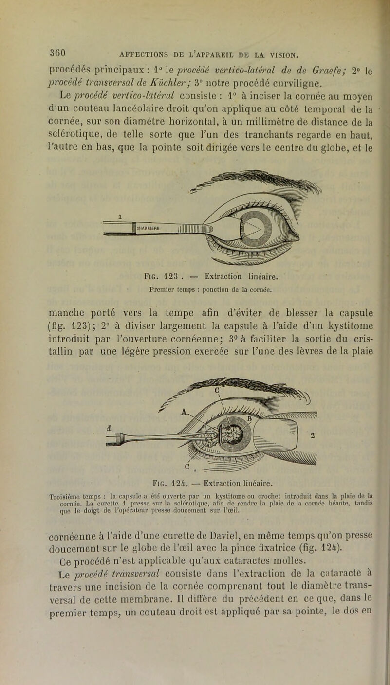 procédés principaux : 1'* le procédé vertico-latéral de de Graefe; 2® le procédé transvei'sal de Kückler; 3“ notre procédé curviligne. Le procédé vertico-latéral consiste ; 1® à inciser la cornée au moyen d'un couteau lancéolaire droit qu’on applique au côté temporal de la cornée, sur son diamètre horizontal, à un millimètre de distance de la sclérotique, de telle sorte que l’un des tranchants regarde en haut, l’autre en bas, que la pointe soit dirigée vers le centre du globe, et le 1 { \ 'i I Fig. 123 . — Extraction linéaire. Premier temps : ponction de la cornée. manche porté vers la tempe afin d’éviter de blesser la capsule (fig. 123); 2® à diviser largement la capsule à l’aide d’un kystitome ’ introduit par l’ouverture cornéenne; 3“ à faciliter la sortie du cris- tallin par une légère pression exercée sur l’une des lèvres de la plaie Fig. 12A. — Extraction linéaire. Troisième temps : la capsule a été ouverte par un kystitome ou crochet introduit dans la plaie de la cornée. La curette 1 presse sur la sclérotique, afin de rendre la plaie de la cornée béante, tandis que le doigt do l’opérateur presse doucement sur l’œil. cornéenne à l’aide d’une curette de Daviel, en même temps qu’on presse doucement sur le globe de l’œil avec la pince fixatrice (fig. 12û). Ce procédé n’est applicable qu’aux cataractes molles. Le procédé transversal consiste dans l’extraction de la cataracte à travers une incision de la cornée comprenant tout le diamètre trans- versal de cette membrane. Il diffère du précédent en ce que, dans le premier temps, un couteau droit est appliqué par sa pointe, le dos en