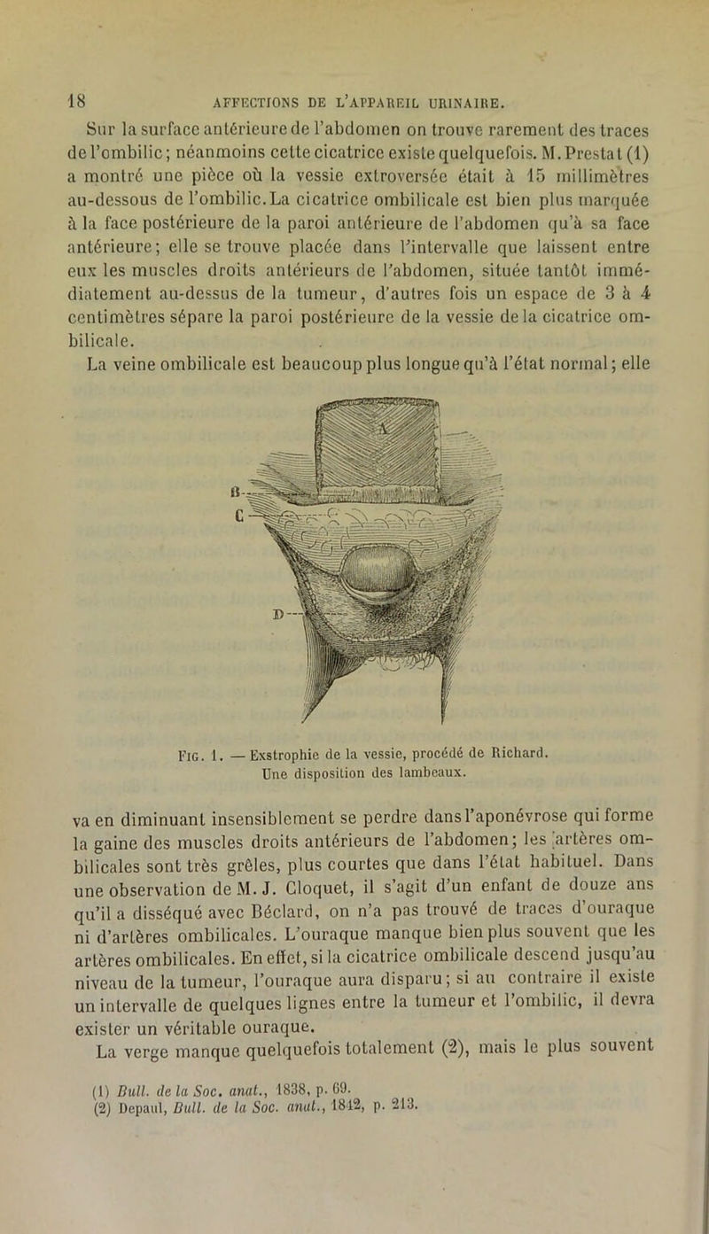 Sur la surface antérieure de l’abdomen on trouve rarement des traces de l’ombilic; néanmoins cette cicatrice existe quelquefois. M.Prestat (1) a montré une pièce où la vessie extroversée était à 15 millimètres au-dessous de l’ombilic.La cicatrice ombilicale est bien plus marquée à la face postérieure de la paroi antérieure de l’abdomen qu’à sa face antérieure; elle se trouve placée dans l’intervalle que laissent entre eux les muscles droits antérieurs de l'abdomen, située tantôt immé- diatement au-dessus de la tumeur, d’autres fois un espace de 3 à centimètres sépare la paroi postérieure de la vessie delà cicatrice om- bilicale. La veine ombilicale est beaucoup plus longue qu’à l’élat normal ; elle Fig. 1. — Exstrophie de la vessie, procédé de Richard. Une disposition des lambeaux. va en diminuant insensiblement se perdre dans l’aponévrose qui forme la gaine des muscles droits antérieurs de l’abdomen; les artères om- bilicales sont très grêles, plus courtes que dans l’état habituel. Dans une observation deM. J. Cloquet, il s’agit d’un enfant de douze ans qu’il a disséqué avec Béclard, on n’a pas trouvé de traces d’ouraque ni d’artères ombilicales. L'ouraque manque bien plus souvent que les artères ombilicales. En etïet, si la cicatrice ombilicale descend jusqu au niveau de la tumeur, l’ouraque aura disparu ; si au contraire il existe un intervalle de quelques lignes entre la tumeur et 1 ombilic, il devra exister un véritable ouraque. La verge manque quelquefois totalement (2), mais le plus souvent (1) Dull. delà Soc. anal., 1838, p. 69. (2) Depaul, Bull, de la Soc. anal., 1812, p. 213.