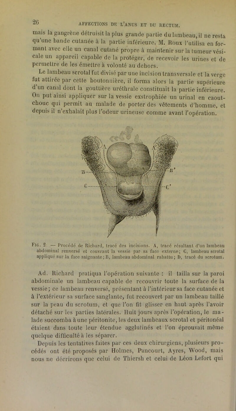 mais la gangrène détruisit la plus grande partie du lambeau, il ne resta qu’une bande cutanée à la partie inférieure. M. Houx l’utilisa en for- mant avec elle un canal cutané propre à maintenir sur la tumeur vési- cale un appareil capable de la protéger, de recevoir les urines et de permettre de les émettre h volonté au dehors. Le lambeau scrotal fut divisé par une incision transversale et la verge fut attirée par celte boutonnière, il forma alors la partie supérieure d un canal dont la gouttière uréthrale constituait la partie inférieure. On put ainsi appliquer sur la vessie exstrophiée un urinai en caout- chouc qui permit au malade de porter des vêtements d’homme, et depuis il n’exhalait plus l’odeur urineuse comme avant l’opération. Fig. 2 — Procédé de Richard, tracé des incisions. A, tracé résultant d’un lambeau abdominal renversé et couvrant la vessie par sa face externe; C, lambeau scrotal appliqué sur la face saignante; B, lambeau abdominal rabattu; D, tracé du scrotum. Ad. Richard pratiqua l’opération suivante : il tailla sur la paroi abdominale un lambeau capable de recouvrir toute la surface de la vessie; ce lambeau renversé, présentant à l’intérieur sa face cutanée et à l’extérieur sa surface sanglante, fut recouvert par un lambeau taillé sur la peau du scrotum, et que l’on fit glisser en haut après l’avoir détaché sur les parties latérales. Huit jours après l’opération, le ma- lade succomba à une péritonite, les deux lambeaux scrotal et péritonéal étaient dans toute leur étendue agglutinés et l’on éprouvait môme quelque difficulté à les séparer. Depuis les tentatives faites par ces deux chirurgiens, plusieurs pro- cédés ont été proposés par Holmes, Pancourl, Ayres, Wood, mais nous ne décrirons que celui de Thiersh et celui de Léon Leforl qui