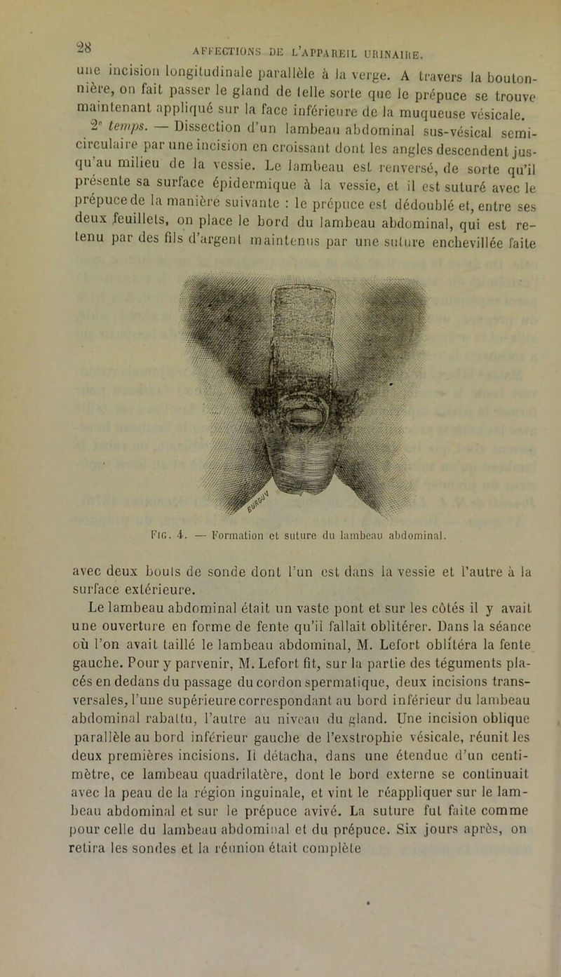 une incision longitudinale parallèle à la verge. A travers la bouton- nière, on fait passer le gland de (elle sorte que le prépuce se trouve maintenant appliqué sur la face inférieure de la muqueuse vésicale. temps. Dissection d’un lambeau abdominal sus-vésical semi- circulaire par une incision en croissant dont les angles descendent jus- qu au milieu de la vessie. Le lambeau est renversé, de sorte qu’il présente sa surlace épidermique à la vessie, et il est suturé avec le prépuce de la maniéré suivante : le prépuce est dédoublé et, entre ses deux feuillets, on place le bord du lambeau abdominal, qui est re- tenu par des fils d’argent maintenus par une. suture enchevillée faite Fig. i. — Formation cl suture du lambeau abdominal. avec deux bouls de sonde dont l’un est dans la vessie et l’autre à la surface extérieure. Le lambeau abdominal était un vaste pont et sur les côtés il y avait une ouverture en forme de fente qu’il fallait oblitérer. Dans la séance où l’on avait taillé le lambeau abdominal, M. Lefort oblitéra la fente gauche. Pour y parvenir, M. Lefort fit, sur la partie des téguments pla- cés en dedans du passage du cordon spermatique, deux incisions trans- versales, l’une supérieure correspondant au bord inférieur du lambeau abdominal rabattu, l’autre au niveau du gland. Une incision oblique parallèle au bord inférieur gauche de l’exstrophie vésicale, réunifies deux premières incisions. Il détacha, dans une étendue d’un centi- mètre, ce lambeau quadrilatère, dont le bord externe se continuait avec la peau de la région inguinale, et vint le réappliquer sur le lam- beau abdominal et sur le prépuce avivé. La suture fut faite comme pour celle du lambeau abdominal et du prépuce. Six jours après, on retira les sondes et la réunion était complète