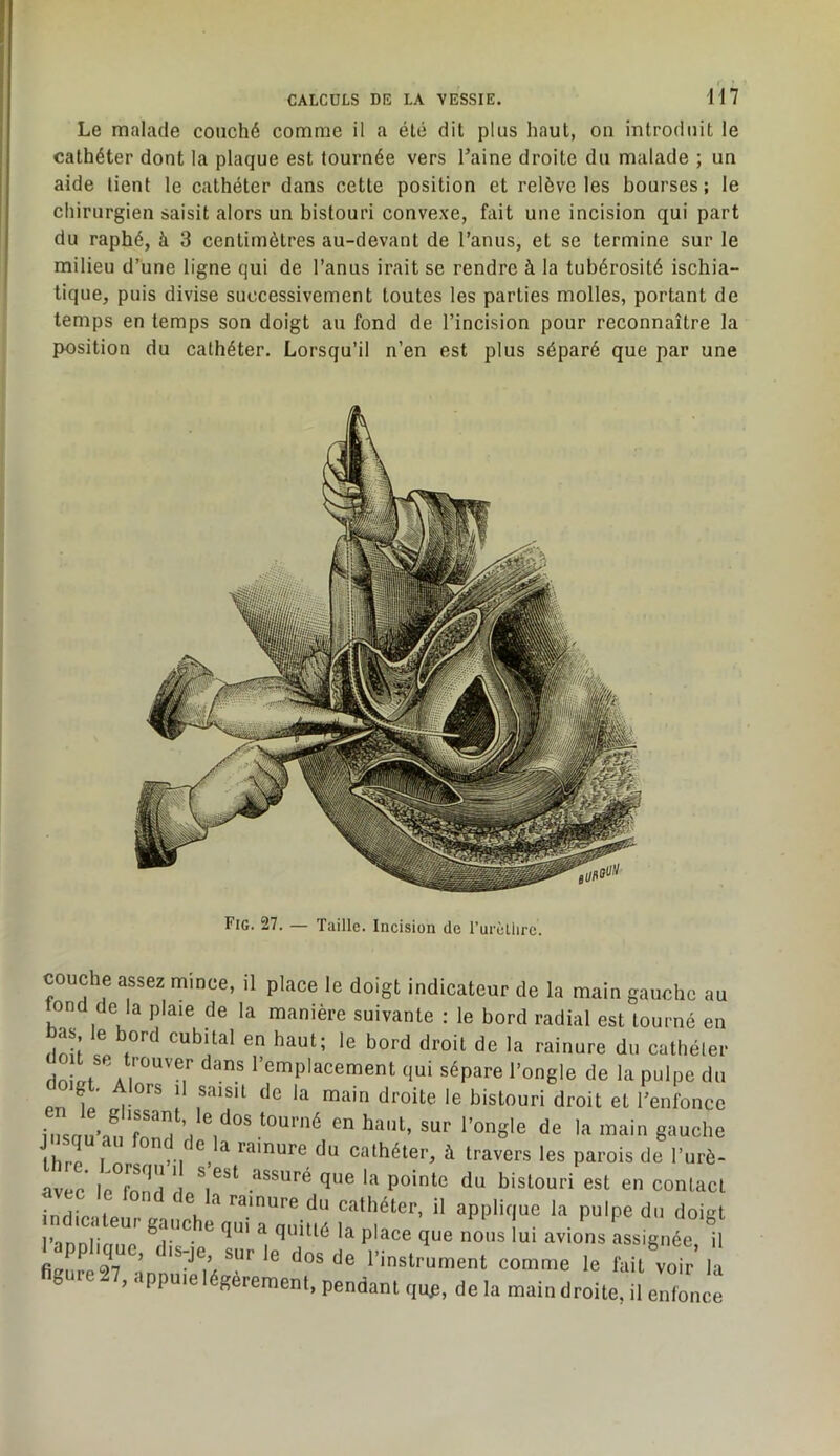 Le malade couché comme il a été dit plus haut, on introduit le cathéter dont la plaque est tournée vers Taine droite du malade ; un aide lient le cathéter dans cette position et relève les bourses; le chirurgien saisit alors un bistouri convexe, fait une incision qui part du raphé, à 3 centimètres au-devant de Tamis, et se termine sur le milieu d’une ligne qui de Tanus irait se rendre à la tubérosité ischia- tique, puis divise successivement toutes les parties molles, portant de temps en temps son doigt au fond de Tincision pour reconnaître la position du cathéter. Lorsqu’il n’en est plus séparé que par une Fig. 27. — Taille. Incision de rurcllire. couche assez mince, il place le doigt indicateur de la main gauche au ond de la plaie de la manière suivante : le bord radial est tourné en bas le bord cubital en haut; le bord droit de la rainure du cathéter ^’®'^P'^cement qui sépare Tongle de la pulpe du Pn 1’ 1-°^^ ! bistouri droit et Tenfoncc iusan’nf r. ihrp I ' ^ cathéter, à travers les parois de Turè- avec le°fond de .^^^ure que la pointe du bistouri est en contact indLteur gmlhlVuTa;^^^^ l’anrvi: ^ ^ p'acc quc iiotis lui avioos assiguéc il lappl.qae, d,s-je sur le dos do l'inslrument comme le fail voir là fi8u.e27, appuie légèrement, pendant qup, delà maindroile, il enfonce