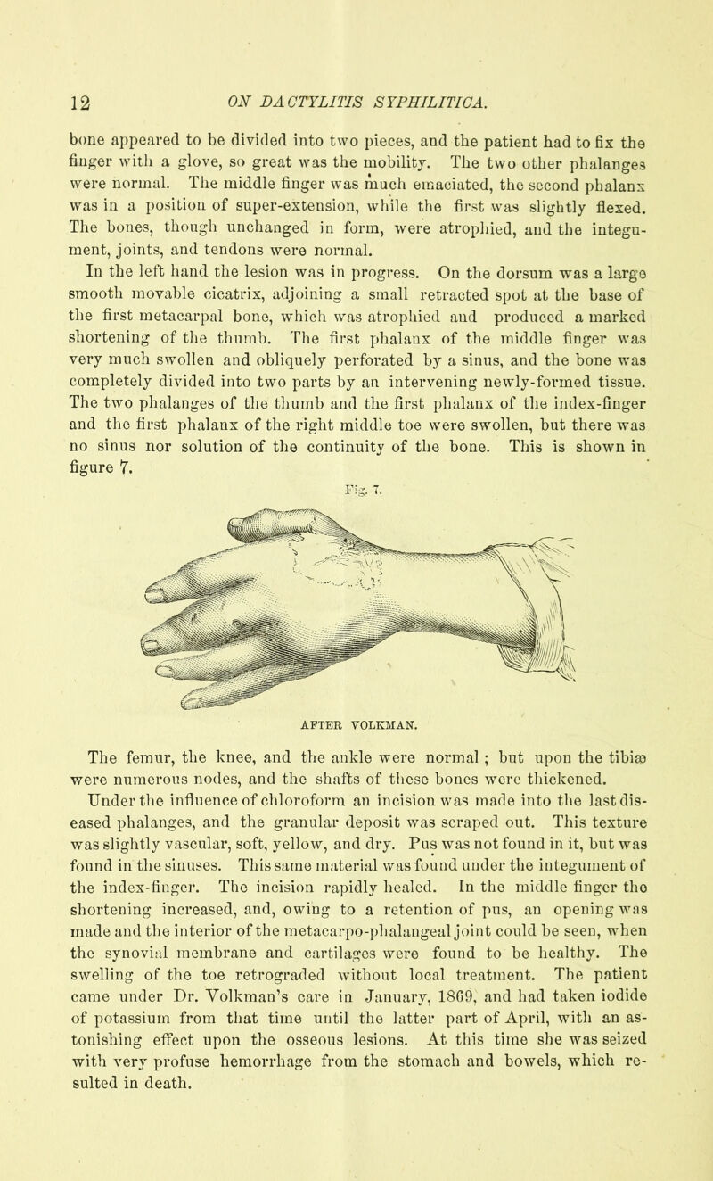 bone appeared to be divided into two pieces, and the patient had to fix the finger with a glove, so great was the mobility. The two other phalanges were normal. The middle finger was much emaciated, the second phalanx was in a position of super-extension, while the first was slightly flexed. The hones, though unchanged in form, were atrophied, and the integu- ment, joints, and tendons were normal. In the left hand the lesion was in progress. On the dorsum was a large smooth movable cicatrix, adjoining a small retracted spot at the base of the first metacarpal bone, which was atrophied and produced a marked shortening of the thumb. The first phalanx of the middle finger was very much swollen and obliquely perforated by a sinus, and the bone was completely divided into two parts by an intervening newly-formed tissue. The two phalanges of the thumb and the first phalanx of the index-finger and the first phalanx of the right middle toe were swollen, but there was no sinus nor solution of the continuity of the bone. This is shown in figure 7. The femur, the knee, and the ankle were normal ; hut upon the tibiso were numerous nodes, and the shafts of these bones were thickened. Under the influence of chloroform an incision was made into the last dis- eased phalanges, and the granular deposit was scraped out. This texture was slightly vascular, soft, yellow, and dry. Pus was not found in it, but was found in the sinuses. This same material was found under the integument of the index-finger. The incision rapidly healed. In the middle finger the shortening increased, and, owing to a retention of pus, an opening was made and the interior of the metacarpo-phalangeal joint could be seen, when the synovial membrane and cartilages were found to be healthy. The swelling of the toe retrograded without local treatment. The patient came under Dr. Yolkman’s care in January, 1869, and had taken iodide of potassium from that time until the latter part of April, with an as- tonishing effect upon the osseous lesions. At this time she was seized with very profuse hemorrhage from the stomach and bowels, which re- sulted in death.