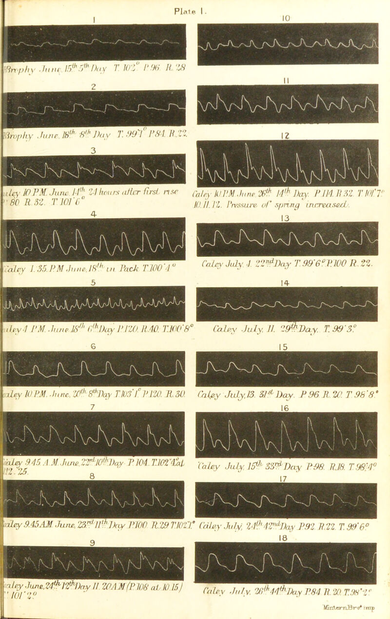 Pl.tle I . 10 .Htvphy .hmr 15*'',Y T lO'f /' %• 11 ‘iS tiiroplty .IIInr. ’5''' J)ay 1.1191 I'SI II.IZ uLcy 10F.M .Jurw I I' 2 ! honns (illir first nsr 80 R ,32. TJOI'f” Calry lUP.M .limp IP HI. R 52 T lOI'T 10 //. It. Ptv.isurp. of' .spring inrrea.wfl. .airy 1 .3.5 PM .Inup. 18' in PacJ< TlOO'r 5 1^'i • . ' •• • • • inhy.l PM. .limp IS' o‘l)c^- PIZO H.10. TJ00'8° Caic^' July ./ 225^Day T.99'6nUU0 11 22. 14 Calry July H. 29'^Day. T.99'5° 6 JVAVjx J\ A fxLey 10PM. .Innc. ‘tP’8'l)ay 7'103 lP120. R.30. 15 Oal^y July. 13. 31^ Day. P 96 R. 2f>. T .98'8 MinlerrLBro* rrap