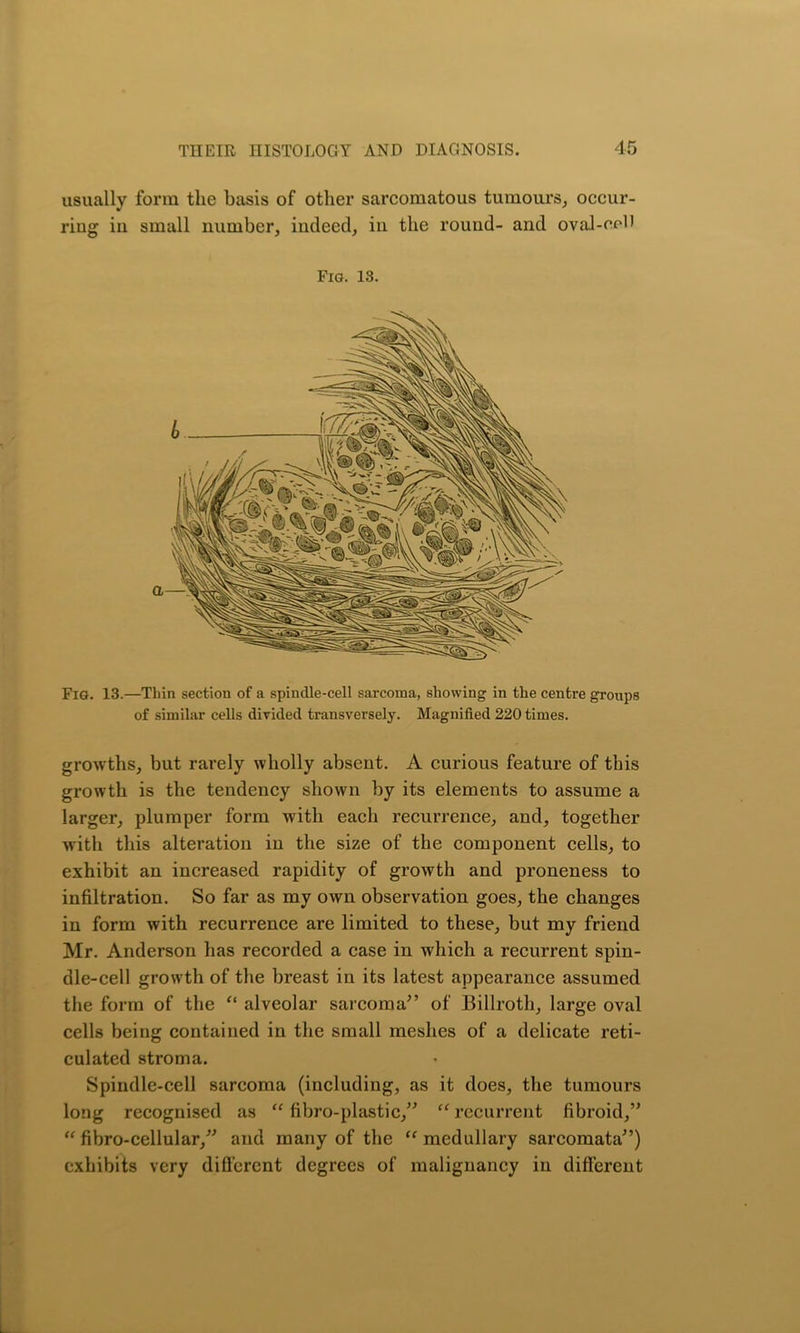 usually form the basis of other sarcomatous tumours, occur- ring in small number, indeed, in the round- and oval-cpD Fig. 13. Fig. 13.—Thin section of a spindle-cell sarcoma, showing in the centre groups of similar cells divided transversely. Magnified 220 times. growths, but rarely wholly absent. A curious feature of this growth is the tendency shown by its elements to assume a larger, plumper form with each recurrence, and, together with this alteration in the size of the component cells, to exhibit an increased rapidity of growth and proneness to infiltration. So far as my own observation goes, the changes in form with recurrence are limited to these, but my friend Mr. Anderson has recorded a case in which a recurrent spin- dle-cell growth of the breast in its latest appearance assumed the form of the “ alveolar sarcoma” of Billroth, large oval cells being contained in the small meshes of a delicate reti- culated stroma. Spindle-cell sarcoma (including, as it does, the tumours long recognised as “ fibro-plastic,” “ recurrent fibroid,” “ fibro-cellular,” and many of the “ medullary sarcomata”) exhibits very different degrees of malignancy in different