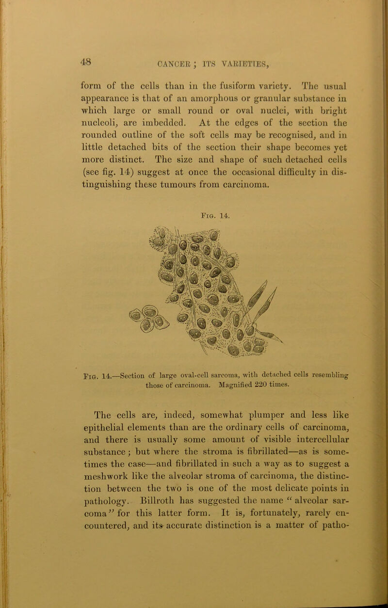 form of the cells than in the fusiform variety. The usual appearance is that of an amorphous or granular substance in which large or small round or oval nuclei, with bright nucleoli, are imbedded. At the edges of the section the rounded outline of the soft cells may be recognised, and in little detached bits of the section their shape becomes yet more distinct. The size and shape of such detached cells (see fig. 14) suggest at once the occasional difficulty in dis- tinguishing these tumours from carcinoma. Fig. 14. Fig. 14.—Section of large oval-cell sarcoma, witli detached cells resembling those of carcinoma. Magnified 220 times. The cells are, indeed, somewhat plumper and less like epithelial elements than are the ordinary cells of carcinoma, and there is usually some amount of visible intercellular substance ; but where the stroma is fibrillated—as is some- times the case—and fibrillated in such a way as to suggest a meshwork like the alveolar stroma of carcinoma, the distinc- tion between the two is one of the most delicate points in pathology. Billroth has suggested the name “ alveolar sar- coma ” for this latter form. It is, fortunately, rarely en- countered, and its- accurate distinction is a matter of patho-