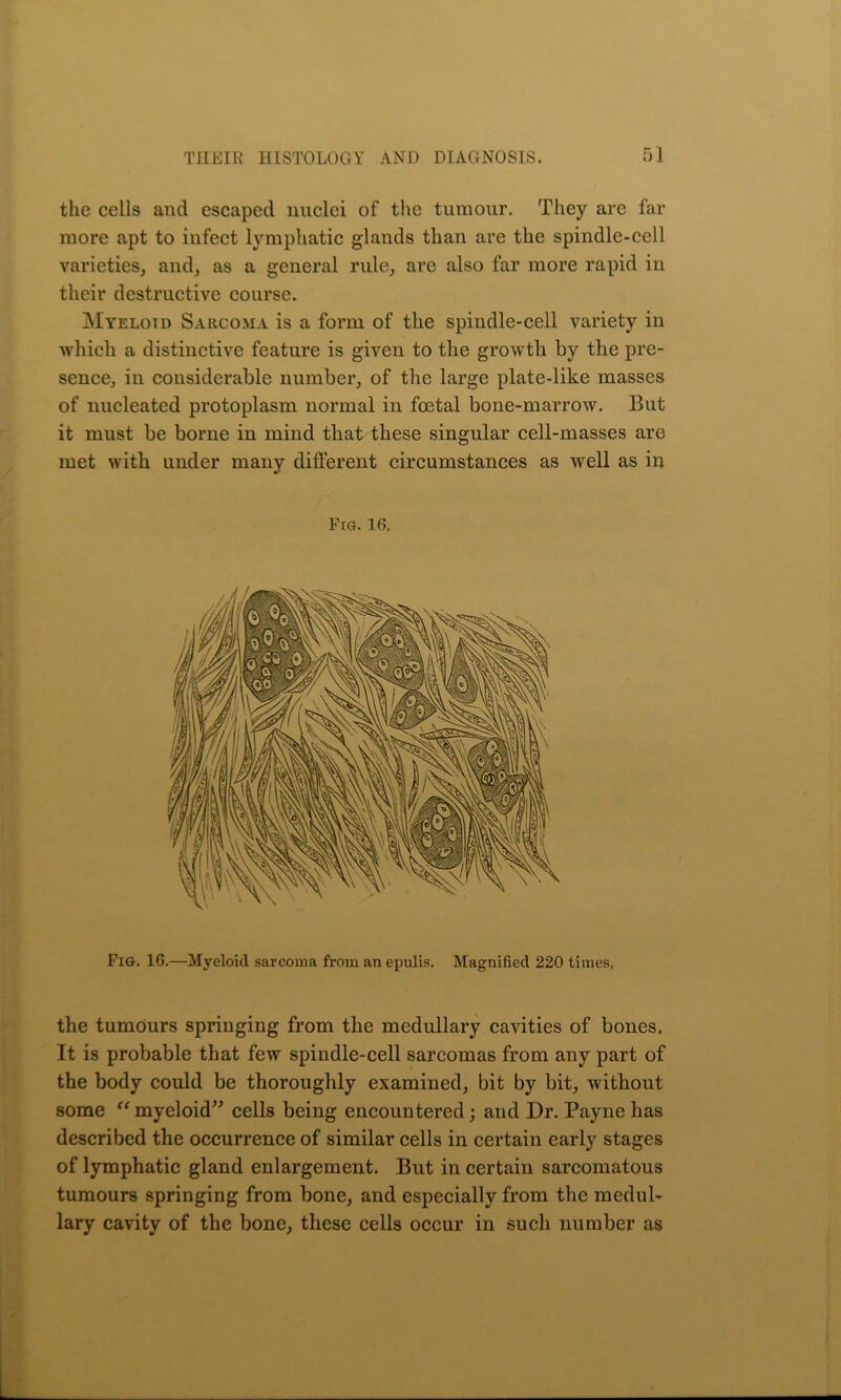 the cells and escaped nuclei of the tumour. They are far more apt to infect lymphatic glands than are the spindle-cell varieties, and, as a general rule, are also far more rapid in their destructive course. Myeloid Sarcoma is a form of the spindle-cell variety in which a distinctive feature is given to the growth by the pre- sence, in considerable number, of the large plate-like masses of nucleated protoplasm normal in foetal bone-marrow. But it must be borne in mind that these singular cell-masses are met with under many different circumstances as well as in Fig. 16. Fig. 16.—Myeloid sarcoma from an epulis. Magnified 220 times, the tumours springing from the medullary cavities of bones. It is probable that few spindle-cell sarcomas from any part of the body could be thoroughly examined, bit by bit, without some “myeloid” cells being encountered; and Dr. Payne has described the occurrence of similar cells in certain early stages of lymphatic gland enlargement. But in certain sarcomatous tumours springing from bone, and especially from the medul- lary cavity of the bone, these cells occur in such number as