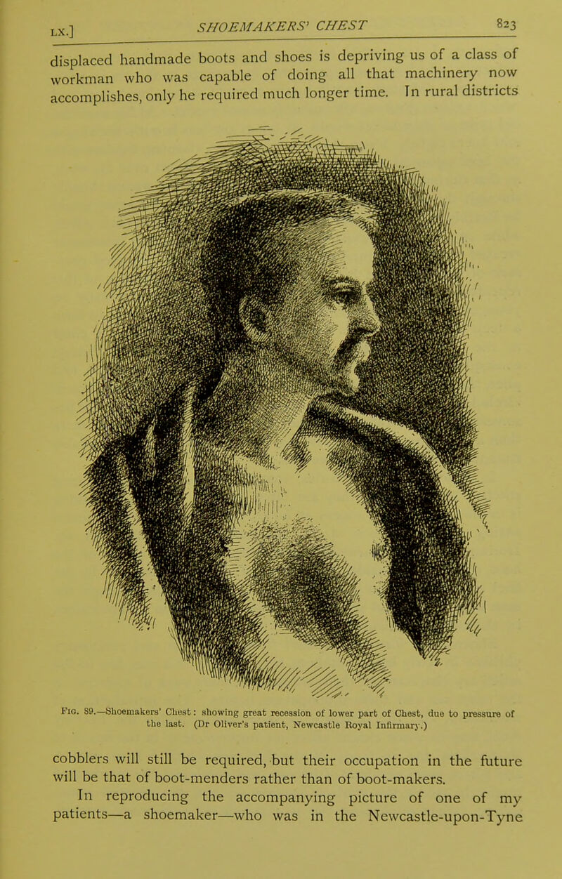 displaced handmade boots and shoes is depriving us of a class of workman who was capable of doing all that machinery now accomplishes, only he required much longer time. In rural districts cobblers will still be required, but their occupation in the future will be that of boot-menders rather than of boot-makers. In reproducing the accompanying picture of one of my patients—a shoemaker—who was in the Newcastle-upon-Tyne