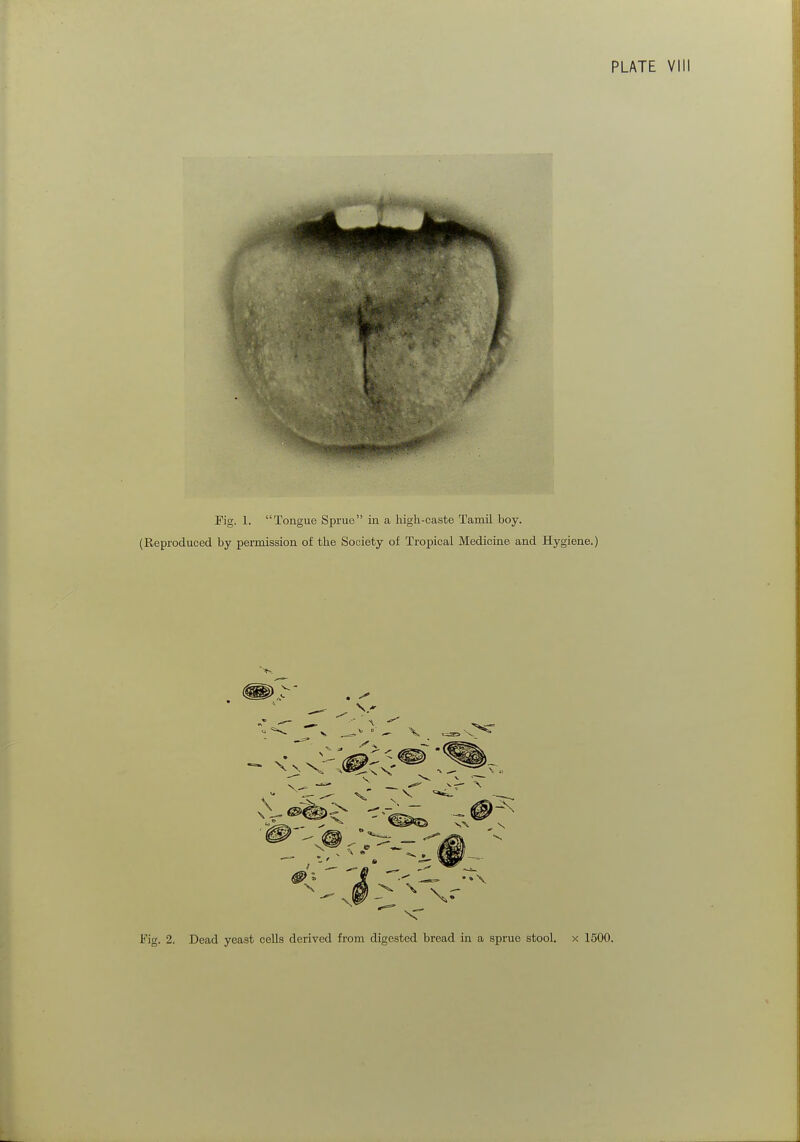 PLATE VIII Fig. 1. Tongue Sprue in a high-caste Tamil boy. (Reproduced by permission of the Society of Tropical Medicine and Hygiene.)