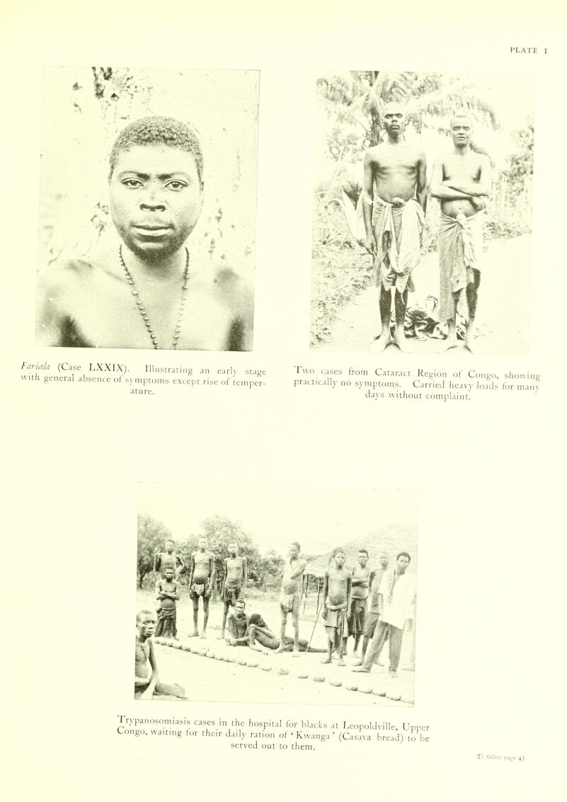 /W* (Case LXXIX). Illustrating an early stage with genera] absence of symptoms except rise of temper- ature. Two cases from Cataract Region of Congo, showing practically no symptoms. Carried heavy loads for many days without complaint.