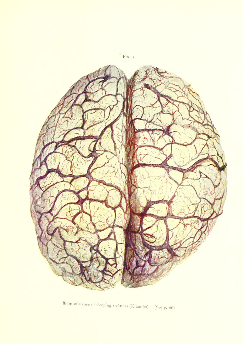 Fig. i Brain of a case of sleeping sickness (Kitambo). (See p. 66)