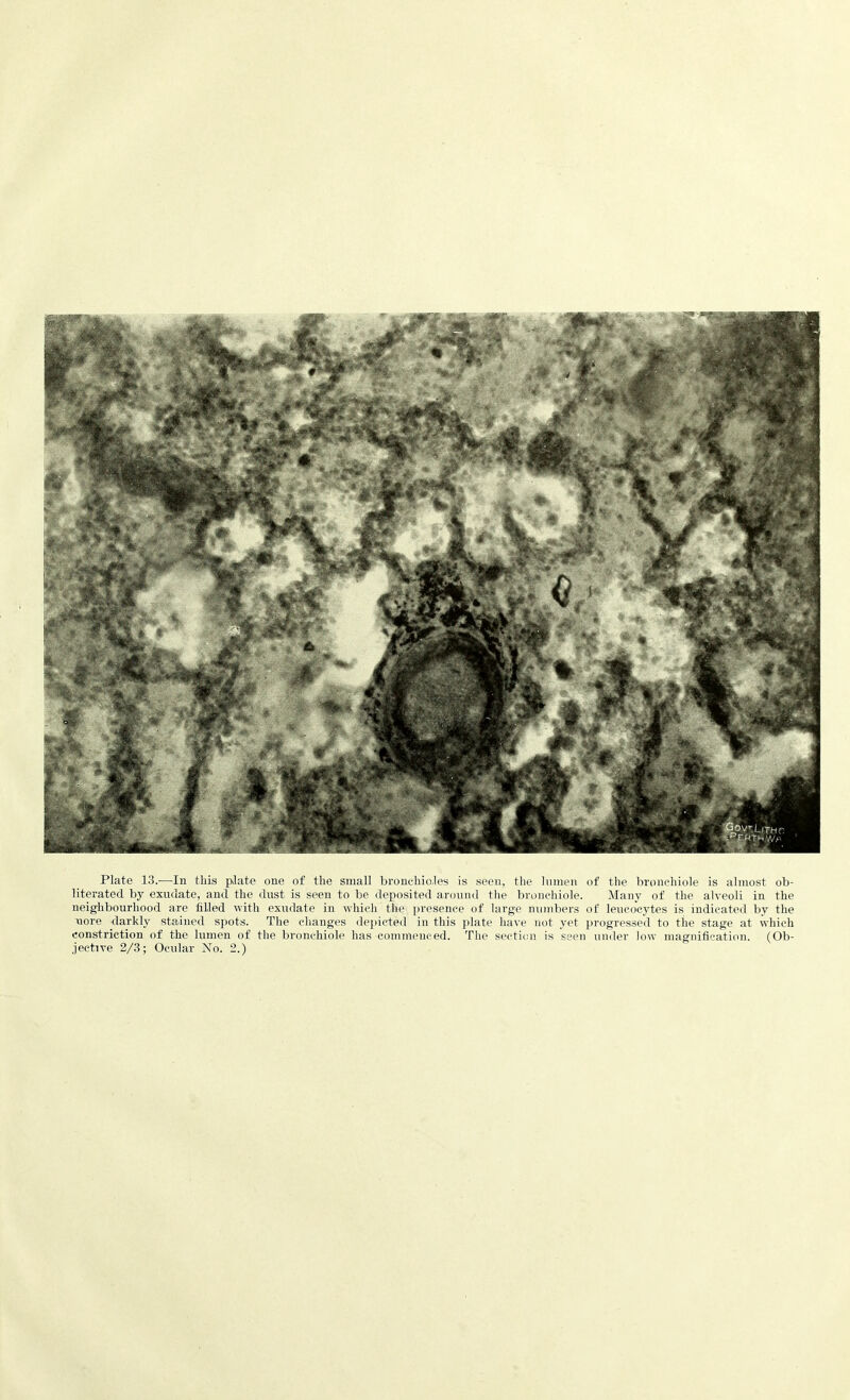 Plate 13.—In this plate one of the small bronchioles is seen, the lumen of the bronchiole is almost ob- literated by exudate, and the dust is seen to be deposited around the bronchiole. Many of the alveoli in the neighbourhood are filled with exudate in which the presence of large numbers of leucocytes is indicated by the uore darkly stained spots. The changes depicted in this plate have not yet progressed to the stage at which constriction of the lumen of the bronchiole has commenced. The section is seen under low magnification. (Ob-