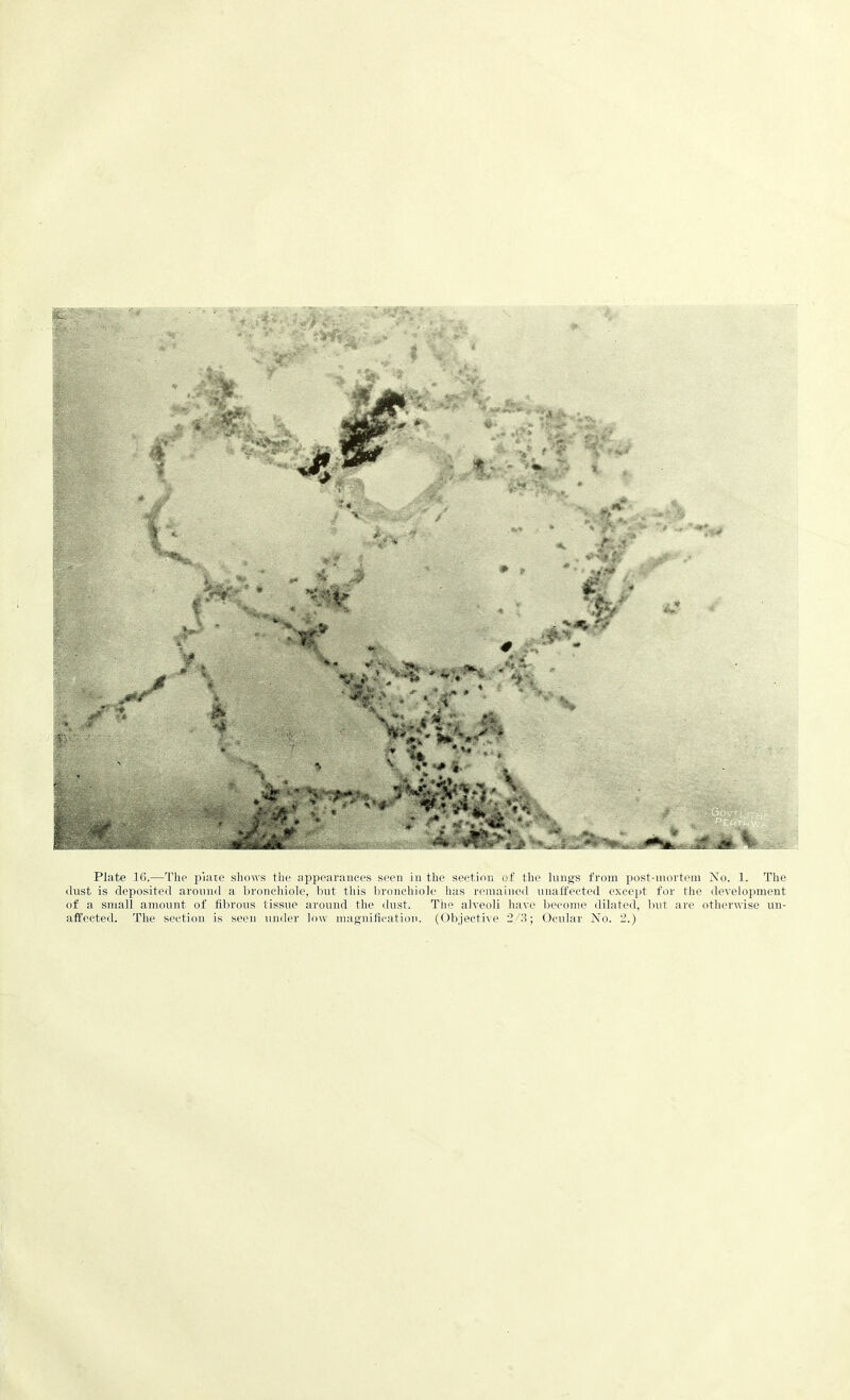 dust is deposited around a bronchiole, but this bronchiole has remained unaffected except for the development of a small amount of fibrous tissue around the dust. The alveoli have become dilated, but are otherwise un-