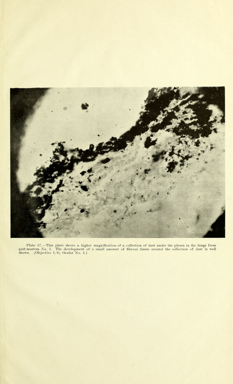 post-mortem No. 1. The development of a small amount of fibrous tissue around the collection of dust is well shown. (Objective 1/6; Oeular No. 4.)