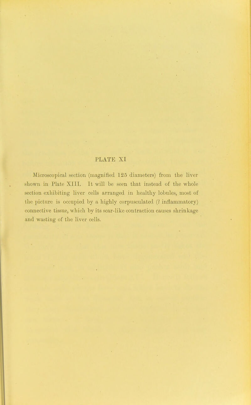 Microscopical section (magnified 125 diameters) from the liver shown in Plate XIII. It will be seen that instead of the whole section exhibiting liver cells arranged in healthy lobules, most of the picture is occupied by a highly corpusculated (? inflammatory) connective tissue, which by its scar-like contraction causes shrinkage and wasting of the liver cells.