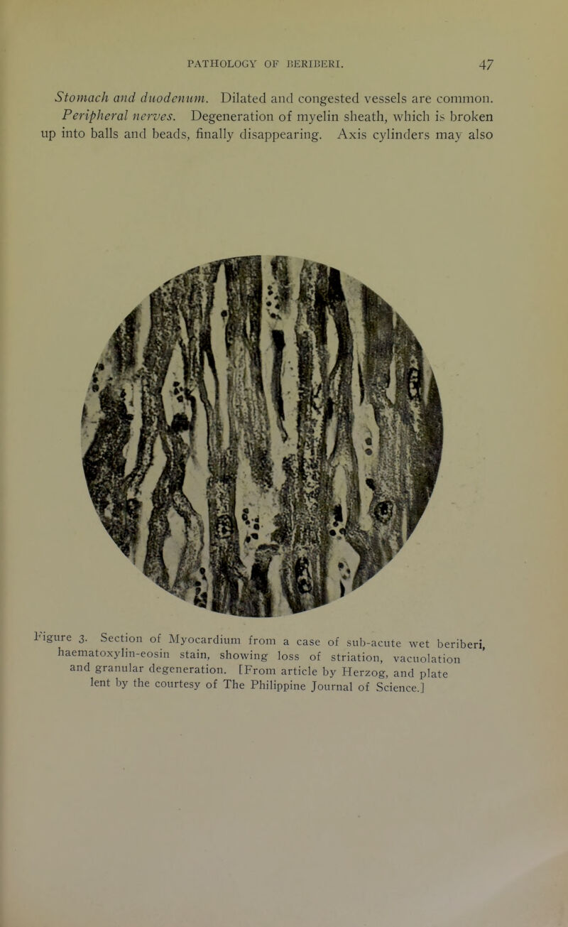 Stomach and duodenum. Dilated and congested vessels are common. Peripheral nerves. Degeneration of myelin sheath, which is broken up into balls and beads, finally disappearing. Axis cylinders may also figure 3. Section of Myocardium from a case of sub-acute wet beriberi, haematoxylin-eosin stain, showing loss of striation, vacuolation and granular degeneration. [From article by Herzog, and plate lent by the courtesy of The Philippine Journal of Science.]