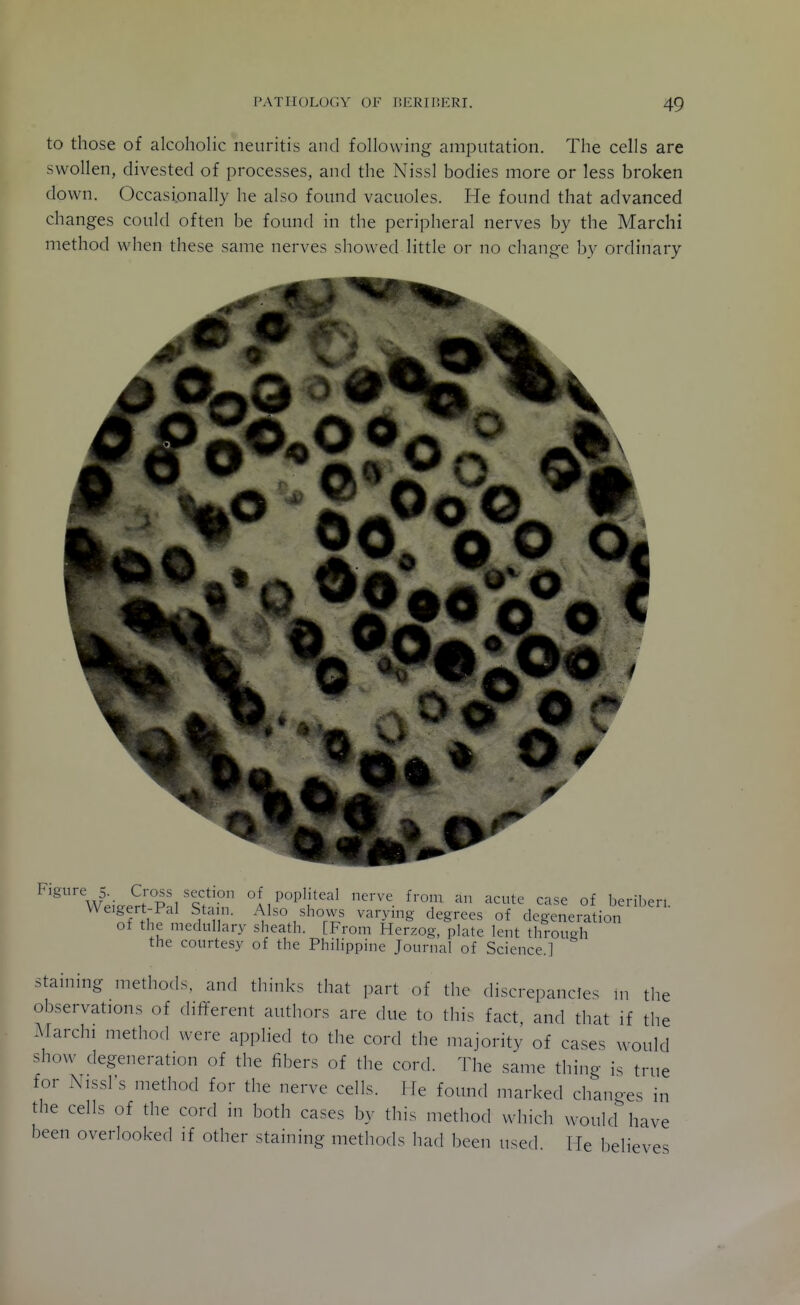 to those of alcoholic neuritis and following amputation. The cells are swollen, divested of processes, and the Nissl bodies more or less broken down. Occasionally he also found vacuoles. He found that advanced changes could often be found in the peripheral nerves by the Marchi method when these same nerves showed little or no change by ordinary Figure 5. C oss section o popliteal nerve from an acute case of beriberi Weigert-Pal Stain. Also shows varying degrees of degeneration of the medullar}- sheath. [From Herzog, plate lent through the courtesy of the Philippine Journal of Science.] Staining methods, and thinks that part of the discrepancies m the observations of different authors are due to thi.s fact and that if the Marchi method were applied to the cord the majority of cases would show degeneration of the fibers of the cord. The same thing is true for Nissl s method for the nerve cells. He foimd marked chano-es in the cells of the cord in both cases by this method which woukrhave been overlooked if other staining methods had been used. He believes