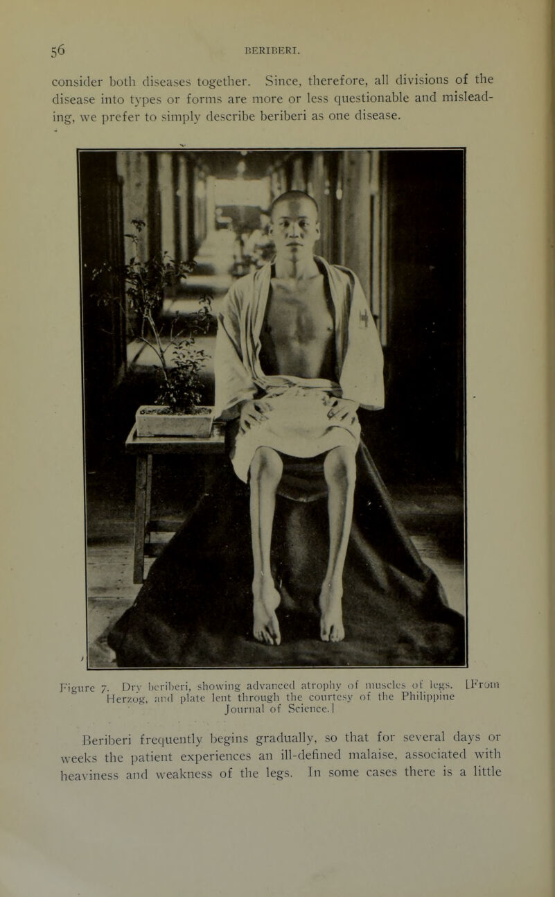 consider both diseases together. Since, therefore, all divisions of the disease into types or forms are more or less questionable and mislead- ing, we prefer to simply describe beriberi as one disease. Figure 7. Dry bcrilieri, showing advanced atrophy of muscles oL' legs. LFruui Herzog, and plate lent through the courtesy of the Philippine Journal of Science. I Beriberi frequently begins gradually, so that for several days or weeks the patient experiences an ill-defined malaise, associated with heaviness and weakness of the legs. In some cases there is a little