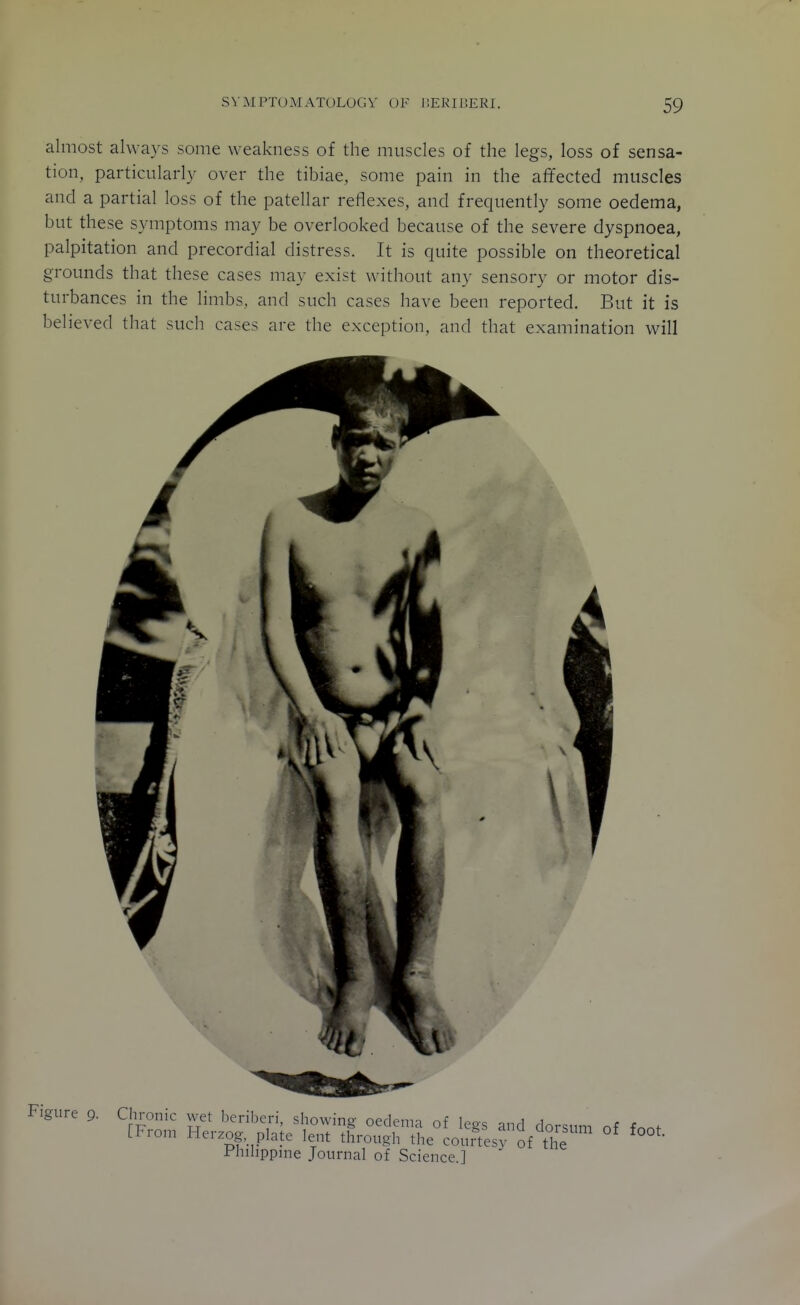 almost always some weakness of the muscles of the legs, loss of sensa- tion, particularly over the tibiae, some pain in the affected muscles and a partial loss of the patellar reflexes, and frequently some oedema, but these symptoms may be overlooked because of the severe dyspnoea, palpitation and precordial distress. It is quite possible on theoretical grounds that these cases may exist without any sensory or motor dis- turbances in the limbs, and such cases have been reported. But it is believed that such cases are the exception, and that examination will *v I Em \ '4 r Figure 9. Chronic wet beriberi, showing oedema of legs and dorsum of fnni- [From Herzog plate lent through the courtesy of the Phihppme Journal of Science.]