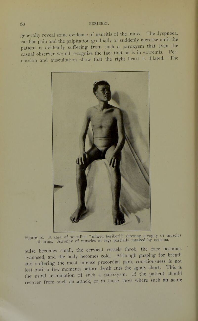 generally reveal some evidence of neuritis of the limbs. The dyspnoea, cardiac pain and the palpitation gradually or suddenly increase until the patient is evidently suffering from such a paroxysm that even the casual observer would recognize the fact that he is in extremis. Per- cussion and auscultation show that the right heart is (hlated. The Fio-ure lO \ case of so-called •'mixed beriberi, showing atrophy of muscles of arms. Atrophy of muscles of legs partially masked by oedema. pulse becomes small, the cervical vessels throb, the face becomes cyanosed, and the body becomes cold. Although gasping for breath and suffering the most intense precordial pain, consciousness is not lost until a few moments before death cuts the agony short. This is the usual termination of such a paroxysm. If the patient should recover from such an attack, or in those cases where such an acute