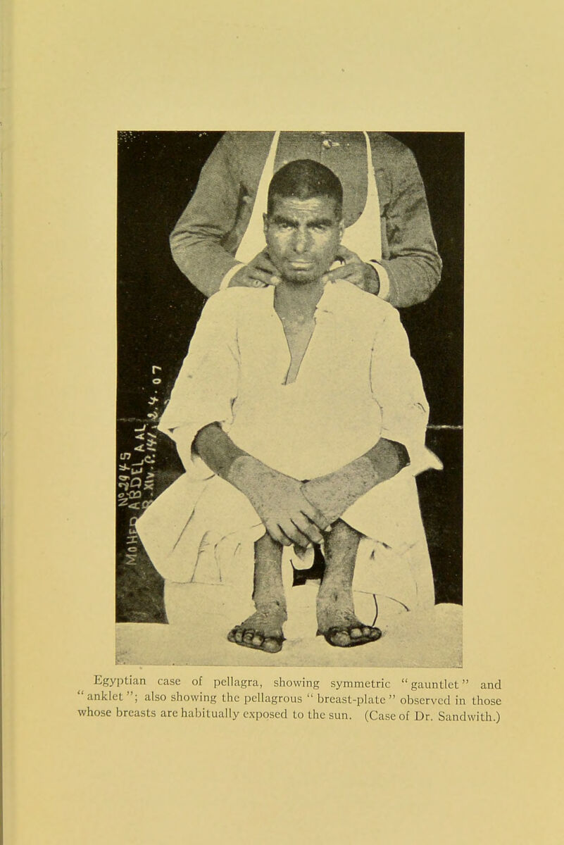 Egyptian case of pellagra, showing symmetric gauntlet and  anklet ; also showing the pellagrous  breast-plate  observed in those whose breasts are habitually exposed to the sun. (Case of Dr. Sandwith.) 1 I I