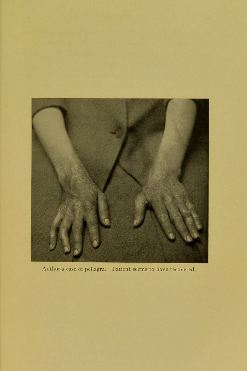 Author's case of pellagra. Patient seems to have recovered.