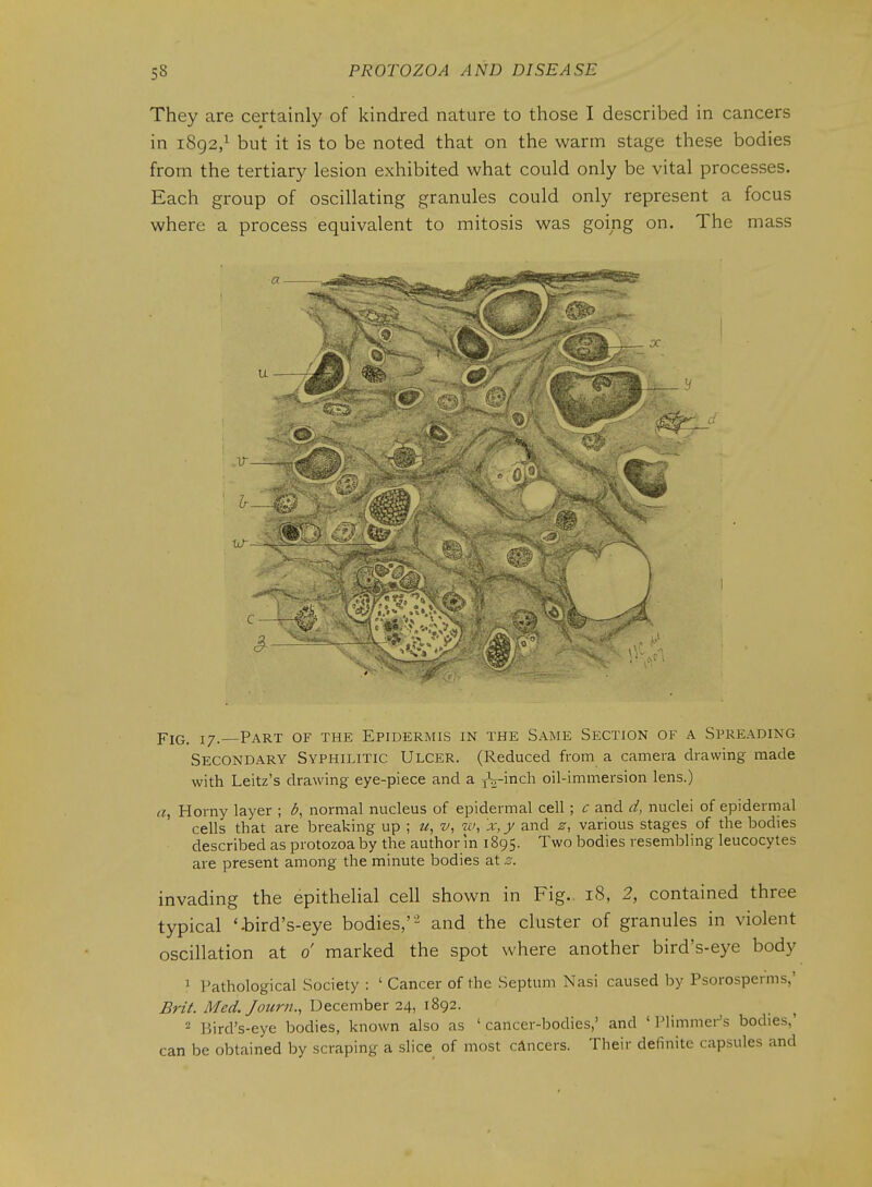 They are certainly of kindred nature to those I described in cancers in 1892,^ but it is to be noted that on the warm stage these bodies from the tertiary lesion exhibited what could only be vital processes. Each group of oscillating granules could only represent a focus where a process equivalent to mitosis was going on. The mass Fig, 17. Part of the Epidermis in the Same Section of a Spreading Secondary Syphilitic Ulcer. (Reduced from a camera drawing made with Leitz's drawing eye-piece and a jV-inch oil-immersion lens.) a, Horny layer ; d, normal nucleus of epidermal cell ; c and d, nuclei of epidermal cells that are breaking up ; u, v, w, 'x,y and various stages of the bodies described as protozoa by the author in 1895. Two bodies resembling leucocytes are present among the minute bodies at s. invading the epithehal cell shown in Fig.. 18, 2, contained three typical '-bird's-eye bodies,' ' and the cluster of granules in violent oscillation at 0 marked the spot where another bird's-eye body 1 Pathological Society : ' Cancer of the Septum Nasi caused by Psorosperms,' Brit. Med.Journ., December 24, 1892. 2 Bird's-eye bodies, known also as 'cancer-bodies,' and ' Plimmer's bodies,' can be obtained by scraping a slice of most cAncers. Their definite capsules and