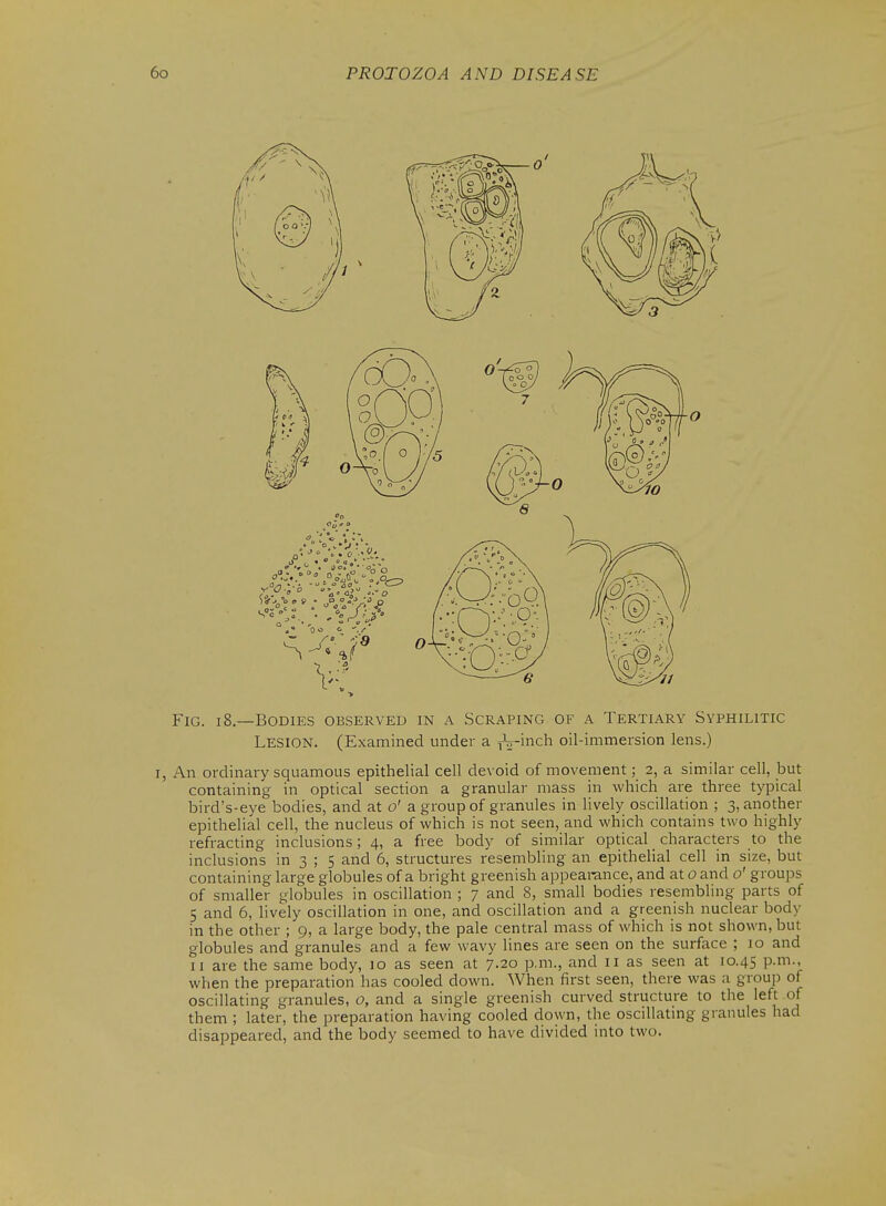 Fig. 18—Bodies observed in a Scraping of a Tertiary Syphilitic Lesion. (Examined under a iW-inch oil-immersion lens.) I, An ordinary squamous epithelial cell devoid of movement; 2, a similar cell, but containing in optical section a granular mass in which are three typical bird's-eye bodies, and at o' a group of granules in lively oscillation ; 3, another epithelial cell, the nucleus of which is not seen, and which contains two highly refracting inclusions; 4, a free body of similar optical characters to the inclusions in 3 ; 5 and 6, structures resembling an epithelial cell in size, but containing large globules of a bright greenish appearance, and at 0 and 0' groups of smaller globules in oscillation ; 7 and 8, small bodies resembling parts of 5 and 6, lively oscillation in one, and oscillation and a greenish nuclear body in the other ; 9, a large body, the pale central mass of which is not shown, but globules and granules and a few wavy lines are seen on the surface ; 10 and II are the same body, 10 as seen at 7.20 p.m., and 11 as seen at 10.45 P-i-, when the preparation has cooled down. When first seen, there was a group of oscillating granules, o, and a single greenish curved structure to the left of them ; later, the preparation having cooled down, the osciUatmg granules had disappeared, and the body seemed to have divided into two.