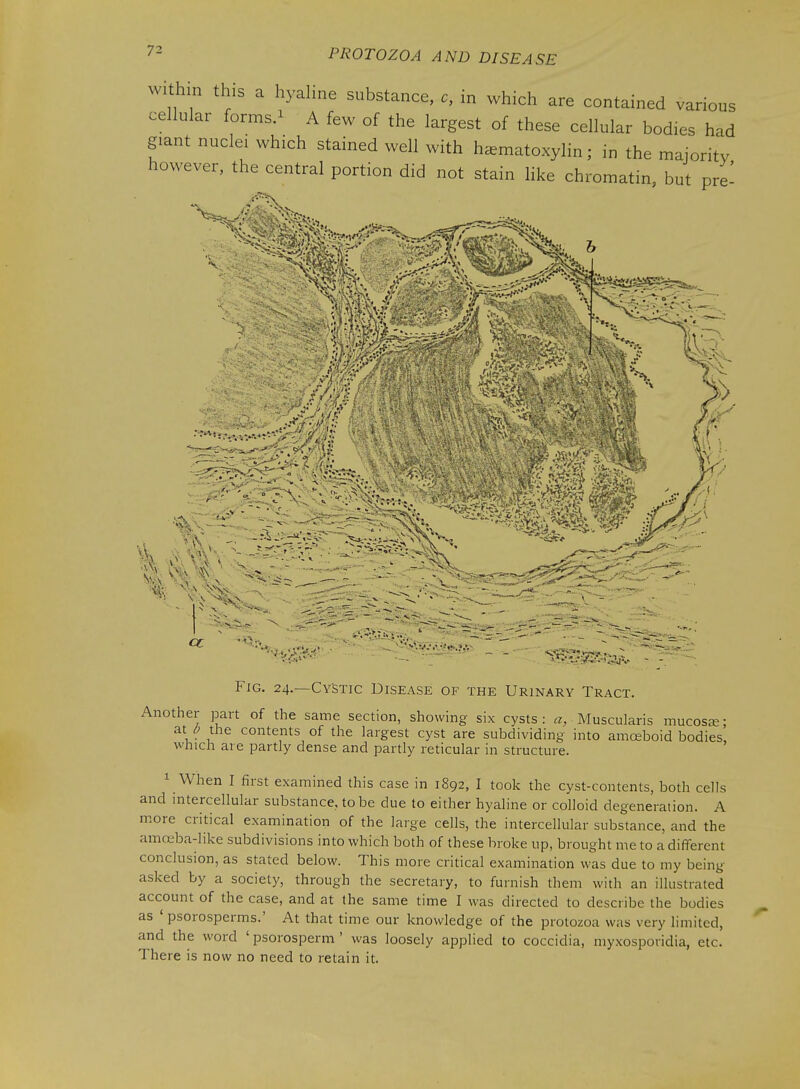 72 within this a hyahne substance, c, in which are contained various cellular forms.^ A few of the largest of these cellular bodies had giant nuclei which stained well with hematoxylin; in the majority however, the central portion did not stain like chromatin, but pre^ cc Fig. 24.—Cystic Disease of the Urinary Tract. Another part of the same section, showing six cysts: Muscularis mucosa; atj; the contents of the largest cyst are subdividing into amceboid bodies, which are partly dense and partly reticular in structure. 1 When I first examined this case in 1892, I took the cyst-contents, both cells and intercellular substance, to be due to either hyaline or colloid degeneration. A more critical examination of the large cells, the intercellular substance, and the amoeba-like subdivisions into which both of these broke up, brought me to a different conclusion, as stated below. This more critical examination was due to my being asked by a society, through the secretary, to furnish them with an illustrated account of the case, and at the same time I was directed to describe the bodies as ' psorosperms.' At that time our knowledge of the protozoa was very limited, and the word ' psorosperm ' was loosely applied to coccidia, myxosporidia, etc. There is now no need to retain it.