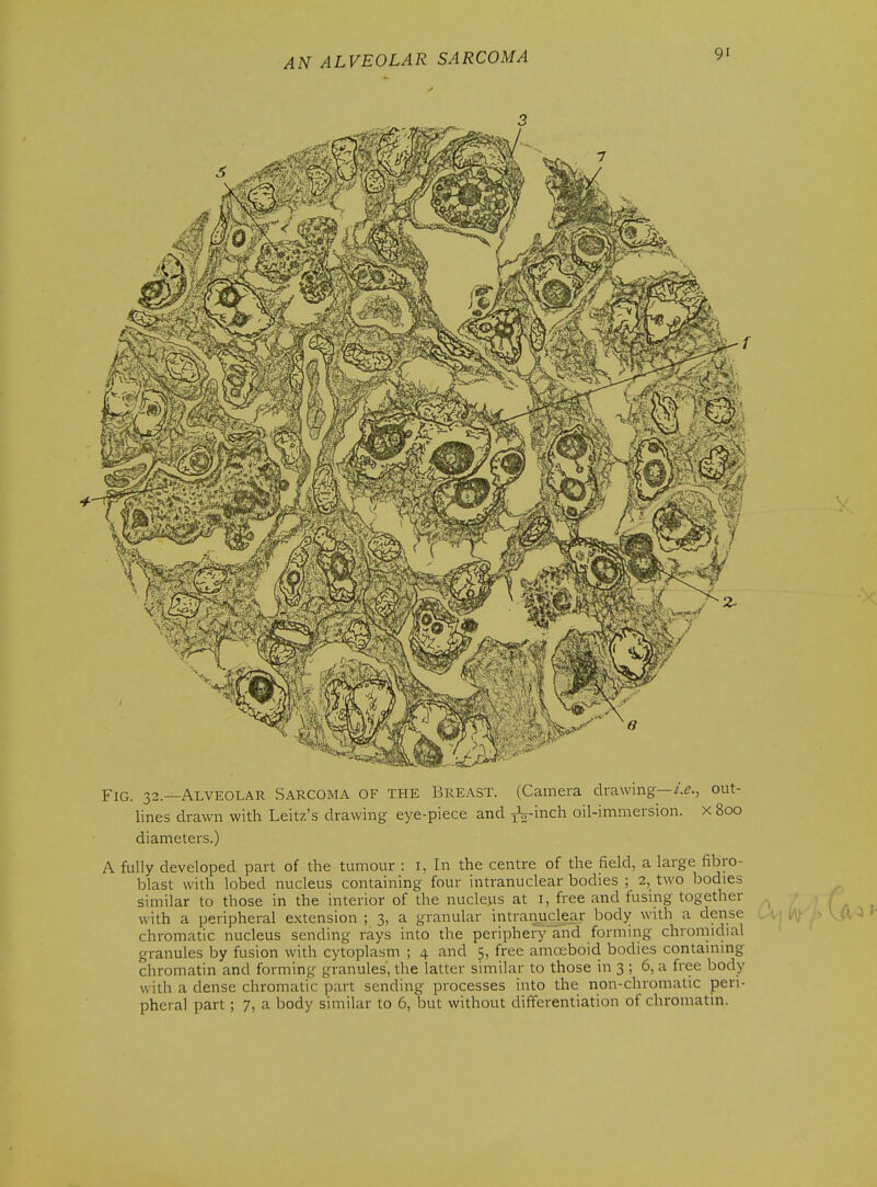 3 Fig. 32.—Alveolar Sarcoma of the Breast. (Camera drawing—out- lines drawn with Leitz's drawing eye-piece and j^-inch oil-immersion, x 800 diameters.) A fully developed part of the tumour : i, In the centre of the field, a large fibro- blast with lobed nucleus containing four intranuclear bodies ; 2, two bodies similar to those in the interior of the nucleus at i, free and fusing together with a peripheral extension ; 3, a granular intranuclear body with a dense chromatic nucleus sending rays into the periphery and forming chromidial granules by fusion with cytoplasm ; 4 and 5, free amoeboid bodies contammg chromatin and forming granules', the latter similar to those in 3 ; 6, a free body with a dense chromatic part sending processes into the non-chromatic peri- pheral part; 7, a body similar to 6, but without diflferentiation of chromatin.