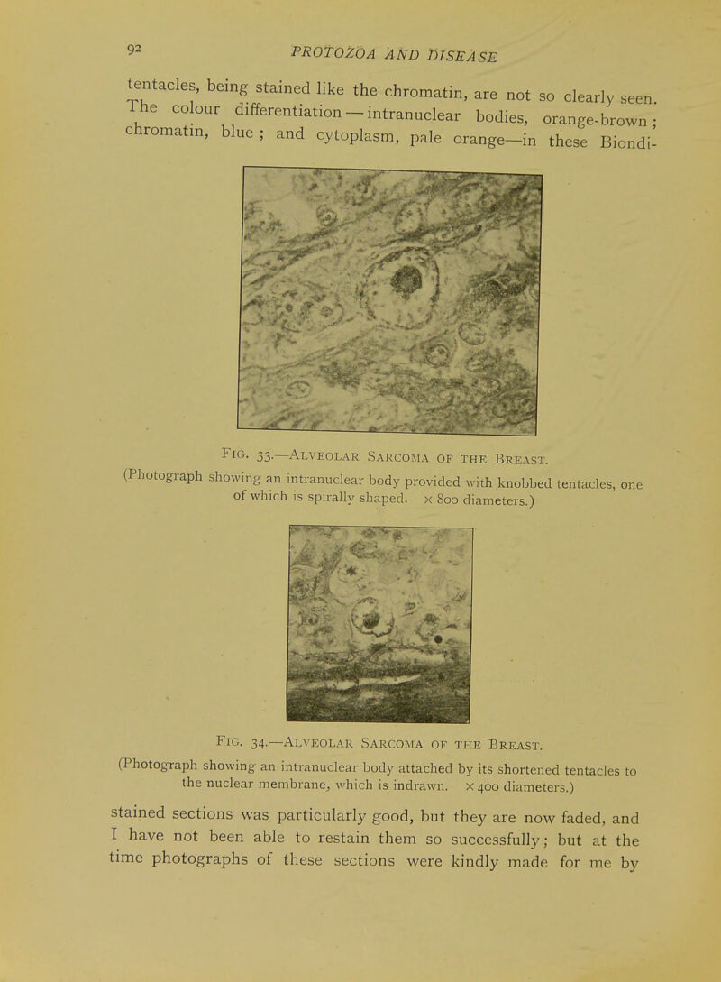 tentacles, being stained like the chromatin, are not so clearly seen The colour differentiation - intranuclear bodies, orange-brown chromatin, blue ; and cytoplasm, pale orange-in these Biondi- ^^G. 33.—Alveolar Sarcorl^ of the Breast. (Photograph showing an intranuclear body provided with knobbed tentacles, one of which is spirally shaped, x 800 diameters.) Fig. 34.—Alveolar Sarcoma of the Breast. (Photograph showing an intranuclear body attached by its shortened tentacles to the nuclear membrane^ which is indrawn. X400 diameters.) Stained sections was particularly good, but they are now faded, and I have not been able to restain them so successfully; but at the time photographs of these sections were kindly made for me by