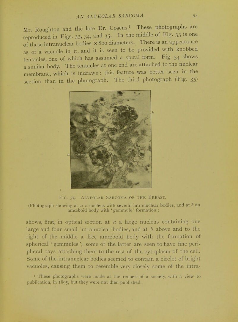 Mr Roughton and the late Dr. Cosens.^ These photographs are reproduced in Figs. 33, 34, and 35- In the middle of Fig. 33 is one of these intranuclear bodies X 8oo diameters. There is an appearance as of a vacuole in it, and it is seen to be provided with knobbed tentacles, one of which has assumed a spiral form. Fig. 34 shows a similar body. The tentacles at one end are attached to the nuclear membrane, which is indrawn; this feature was better seen in the section than in the photograph. The third photograph (Fig. 35) f Fig. 35.—Alveolar Sarcoma of the Breast. (Photograph showing at a a nucleus with several intranuclear bodies, and at d an amoeboid body with 'gemmule ' formation.) shows, first, in optical section at a a large nucleus containing one large and four small intranuclear bodies, and at b above and to the right of the middle a free amoeboid body with the formation of spherical ' gemmules some of the latter are seen to have fine peri- pheral rays attaching them to the rest of the cytoplasm of the cell. Some of the intranuclear bodies seemed to contain a circlet of bright vacuoles, causing them to resemble very closely some of the intra- ' These photographs were made at the request of a society, with a view to publication, in 1895, but they were not then published.