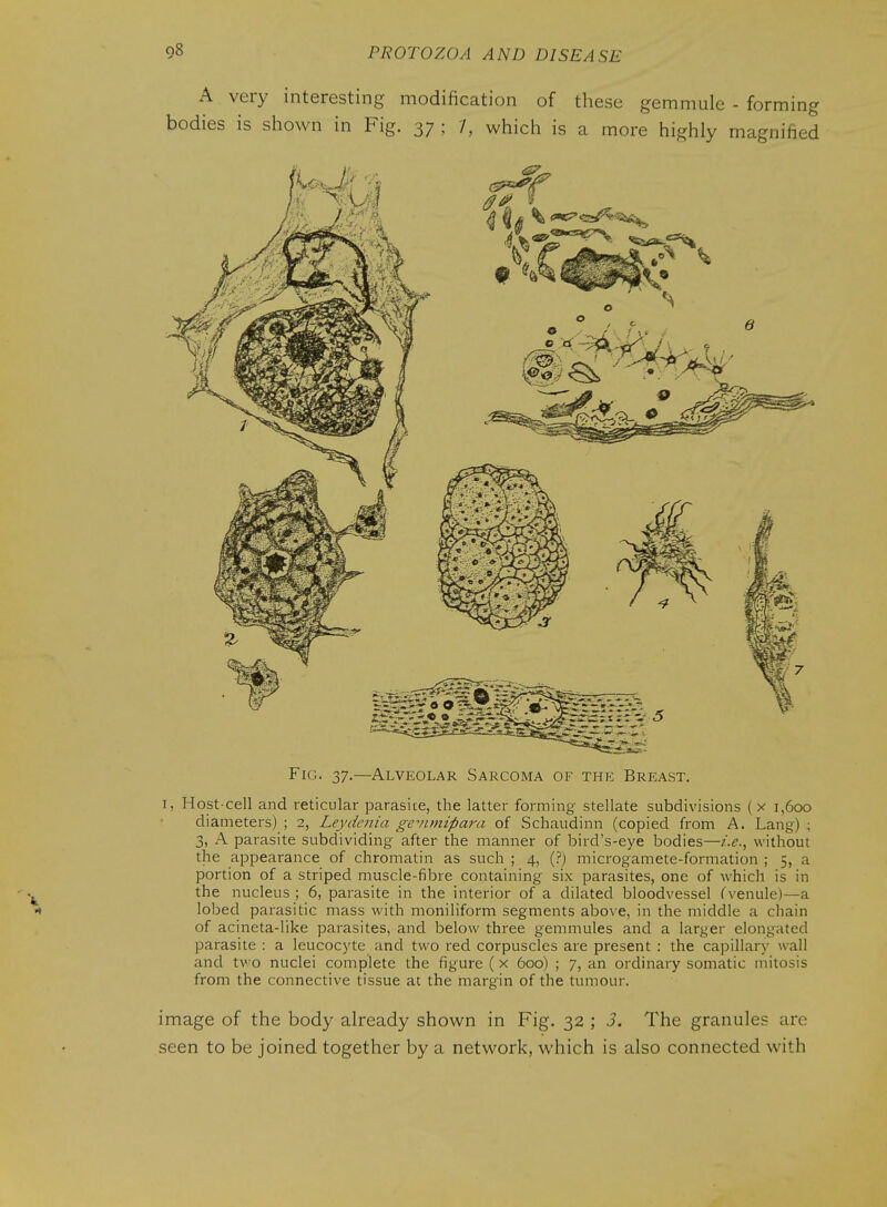 A very interesting modification of these gemmule - forming bodies is shown in Fig. 37 ; 7, which is a more highly magnified Fig. 37.—Alveolar Sarcoma of the Breast. I, Host-cell and reticular parasite, the latter forming stellate subdivisions (x 1,600 diameters) ; 2, Lej/denia gevimipara of Schaudinn (copied from A. Lang) ; 3, A parasite subdividing after the manner of bird's-eye bodies—i.e., without the appearance of chromatin as such ; 4, (?) microgamete-formation ; 5, a portion of a striped muscle-fibre containing six parasites, one of which is in the nucleus ; 6, parasite in the interior of a dilated bloodvessel (venule)—a 1 lobed parasitic mass with moniliform segments above, in the middle a chain of acineta-like parasites, and below three gemmules and a larger elongated parasite : a leucocyte and two red corpuscles are present : the capillary wall and two nuclei complete the figure ( x 600) ; 7, an ordinary somatic mitosis from the connective tissue at the margin of the tumour. image of the body already shown in Fig. 32 ; J. The granules are seen to be joined together by a network, which is also connected with