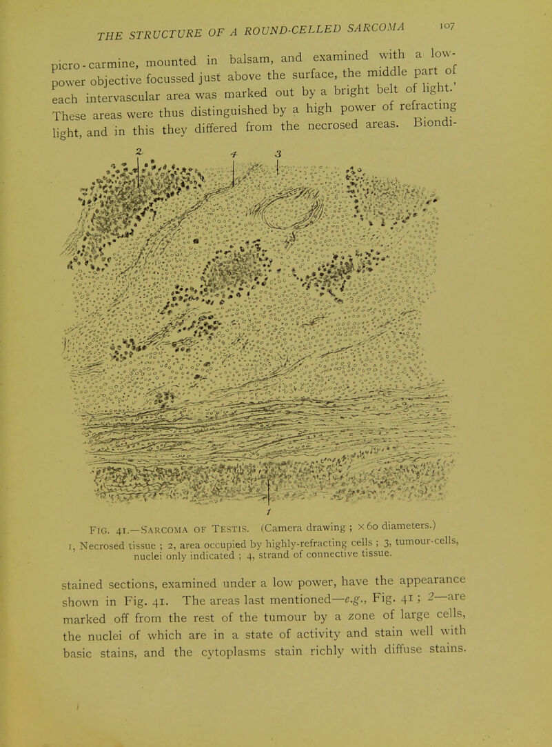 p.cro-carmine, mounted in balsam, and examined with a lo.- power objective focussed just above the surface, the middle part of each intervascular area was marked out by a bright be t of light. These areas were thus distinguished by a high power of refracting light and in this they differed from the necrosed areas. Biondi- FiG. 41—Sarcoma of Testis. (Camera drawing ; x 60 diameters.) 7, Necrosed tissue ; 2, area occupied by highly-refracting cells ; 3, tumour-cells, nuclei only indicated ; 4, strand of connective tissue. stained sections, examined under a low power, have the appearance shown in Fig. 41. The areas last mentioned—e.g., Fig. 41 ; 2—are marked off from the rest of the tumour by a zone of large cells, the nuclei of which are in a state of activity and stain well with basic stains, and the cytoplasms stain richly with diffuse stains. I