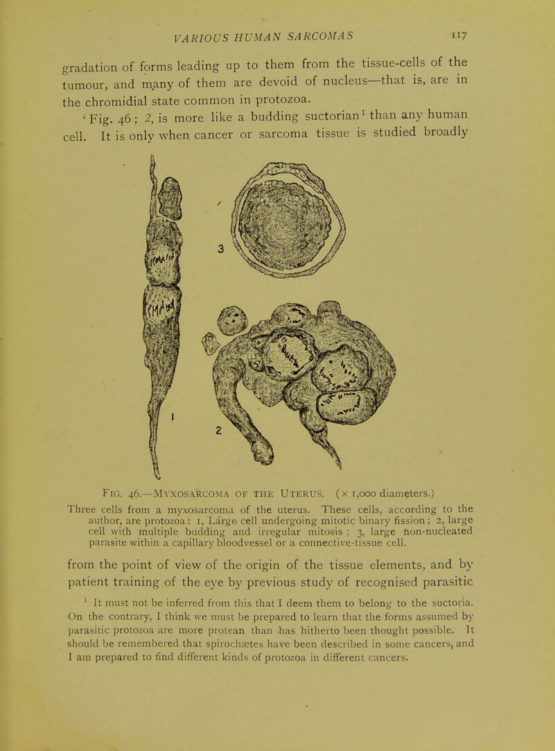 gradation of forms leading up to them from the tissue-cells of the tumour, and many of them are devoid of nucleus—that is, are in the chromidial state common in protozoa. ' Fig. 46 ; 2, is more like a budding suctorian^ than any human cell. It is only when cancer or sarcoma tissue is studied broadly Fig. 46.—Myxosarcoma of the Uterus, (x 1,000 diameters.) Three cells from a myxosarcoma of the uterus. These cells, according to the author, are protozoa: i, Large cell undergoing mitotic binary fission; 2, large cell with multiple budding and irregular mitosis ; 3, large non-nucleated parasite within a capillary bloodvessel or a connective-tissue cell. from the point of view of the origin of the tissue elements, and by patient training of the eye by previous study of recognised parasitic ^ It must not be inferred from this that I deem them to belong to the suctoria. On the contrary, I think we must be prepared to learn that the forms assumed by parasitic protozoa are more protean than -has hitherto been thought possible. It should be remembered that spirochsetes have been described in some cancers, and I am prepared to find different kinds of protozoa in different cancers.