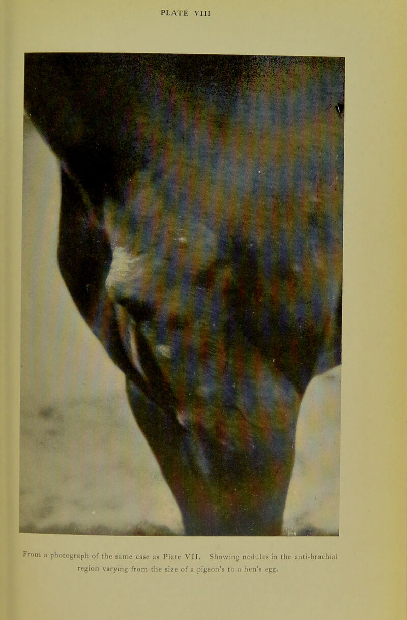From a photograph of the same case as Plate VII. Sliowiiii; nodules in tiu- ajiti-brachial region varying from the size of a pigeon's to a hen's egg.