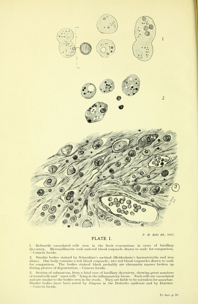 P, H. Bahr del., 1911. PLATE I. 1. Refractile vacuolated cells seen in the fresh evacuations in cases of bacillary dysentery. Micromillimetre scale and red blood corpuscle drawn to scale for comparison. —Camera lucida. 2. Similar bodies stained by Schaudinn's method (Heidenhain's haematoxylin and iron alum). One body contains a red blood corpuscle; two red blood corpuscles drawn to scale for comparison. The bodies stained black probably are chromatin masses broken up during process of degeneration.—Camera lucida. 3. Section of submucosa, from a fatal case of bacillary dysentery, showing great numbers of round cells and'' mast cells  lying in the inflammatory tissue. Such cells are vacuolated and are similar to the bodies seen in the stools. They are liable to be mistaken for amoebae. Similar bodies have been noted by Jurgens in the Doberitz epidemic and by Dutcher. —Camera lucida.