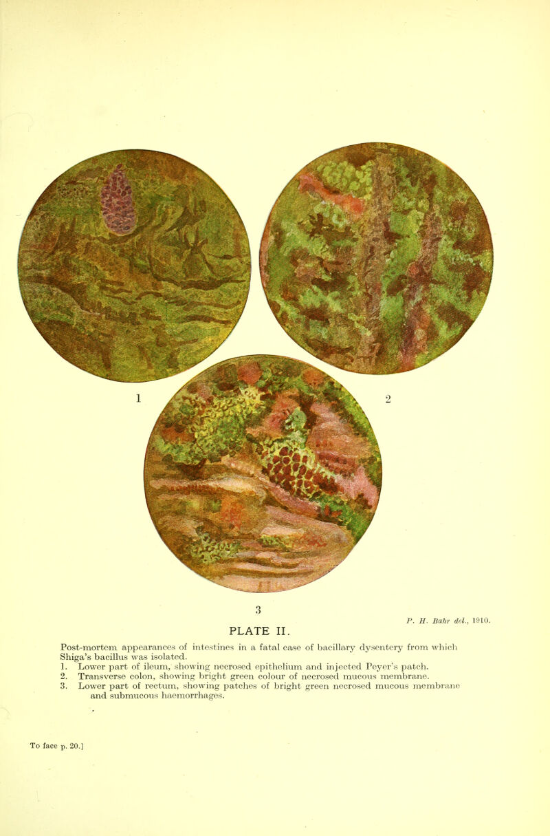 3 P. H. Bahr del., 1910. PLATE II. Post-mortem appearances of intestines in a fatal case of bacillary dysentery from which Shiga's bacillus was isolated. 1. Lower part of ileum, showing necrosed epithelium and injected Peyer's patch. 2. Transverse colon, showing bright green colour of necrosed mucous membrane. 3. Lower part of rectum, showing patches of bright green necrosed mucous membrane and submucous haemorrhages.