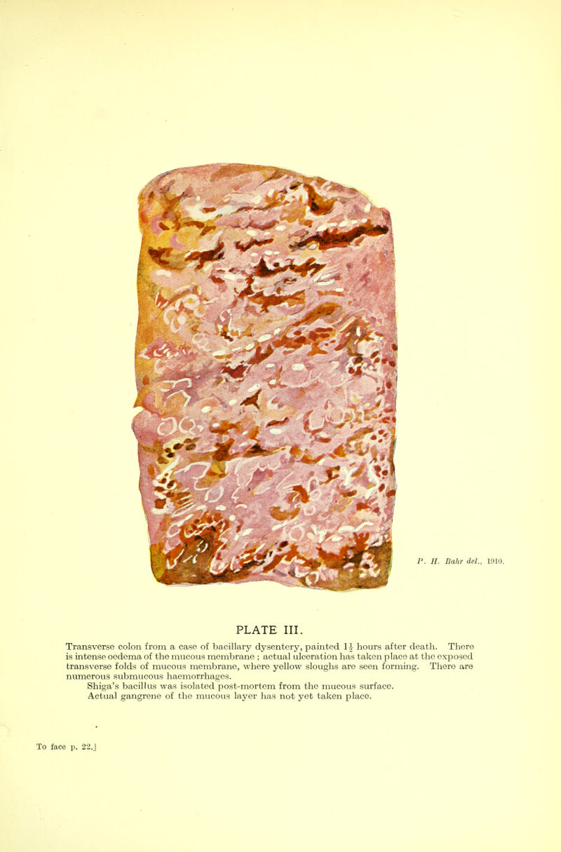 PLATE III. Transverse colon from a case of bacillary dysentery, painted H hours after death. There is intense oedema of the mucous membrane ; actual ulceration has taken place at the exposed transverse folds of mucous membrane, where yellow sloughs are seen forming. There are numerous submucous haemorrhages. Shiga's bacillus was isolated post-mortem from the mucous surface. Actual gangrene of the mucous layer has not yet taken place.