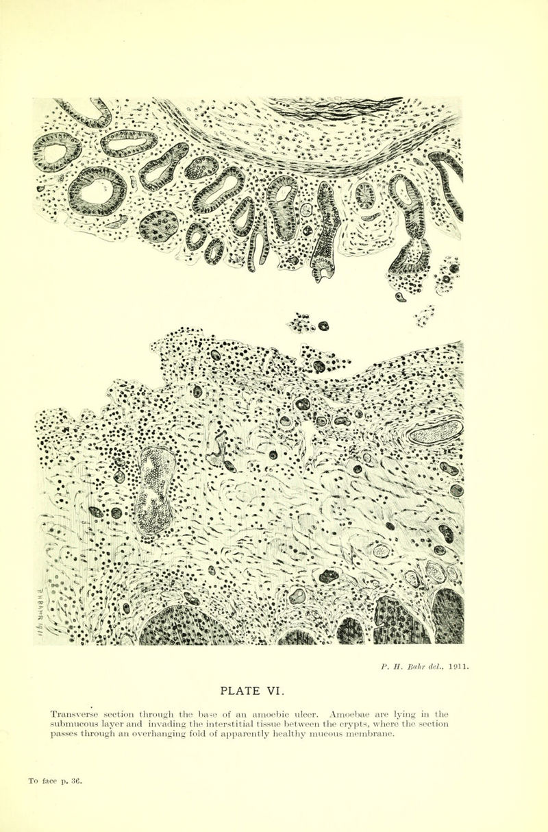 PLATE VI. Transverse section through the base of an amoebic ulcer. Amoebae are lying in the submucous layer and invading the interstitial tissue between the crypts, where the section passes through an overhanging fold of apparently healthy mucous membrane.