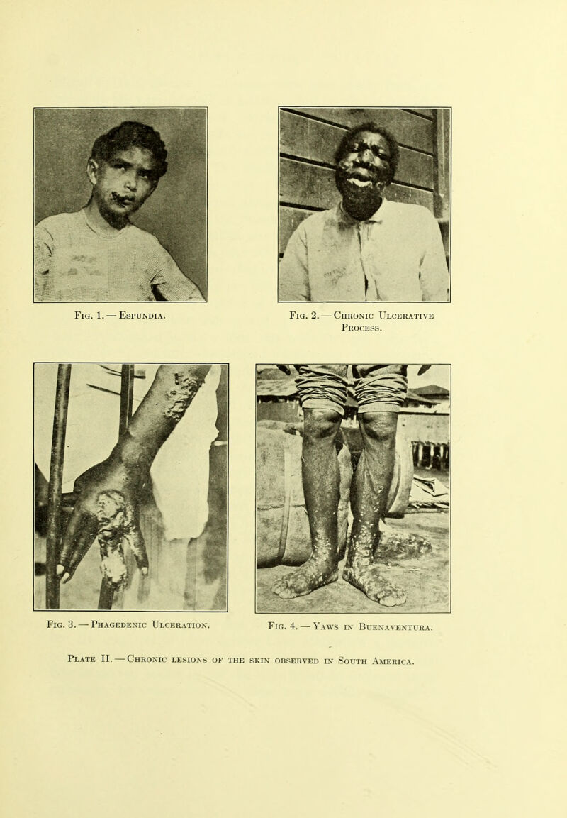 Fig. 3.—-Phagedenic Ulceration. Fig. 4. — Yaws i.\ Btexan kntuua. Plate II. — Chronic lesions of the skin observed in .South America.