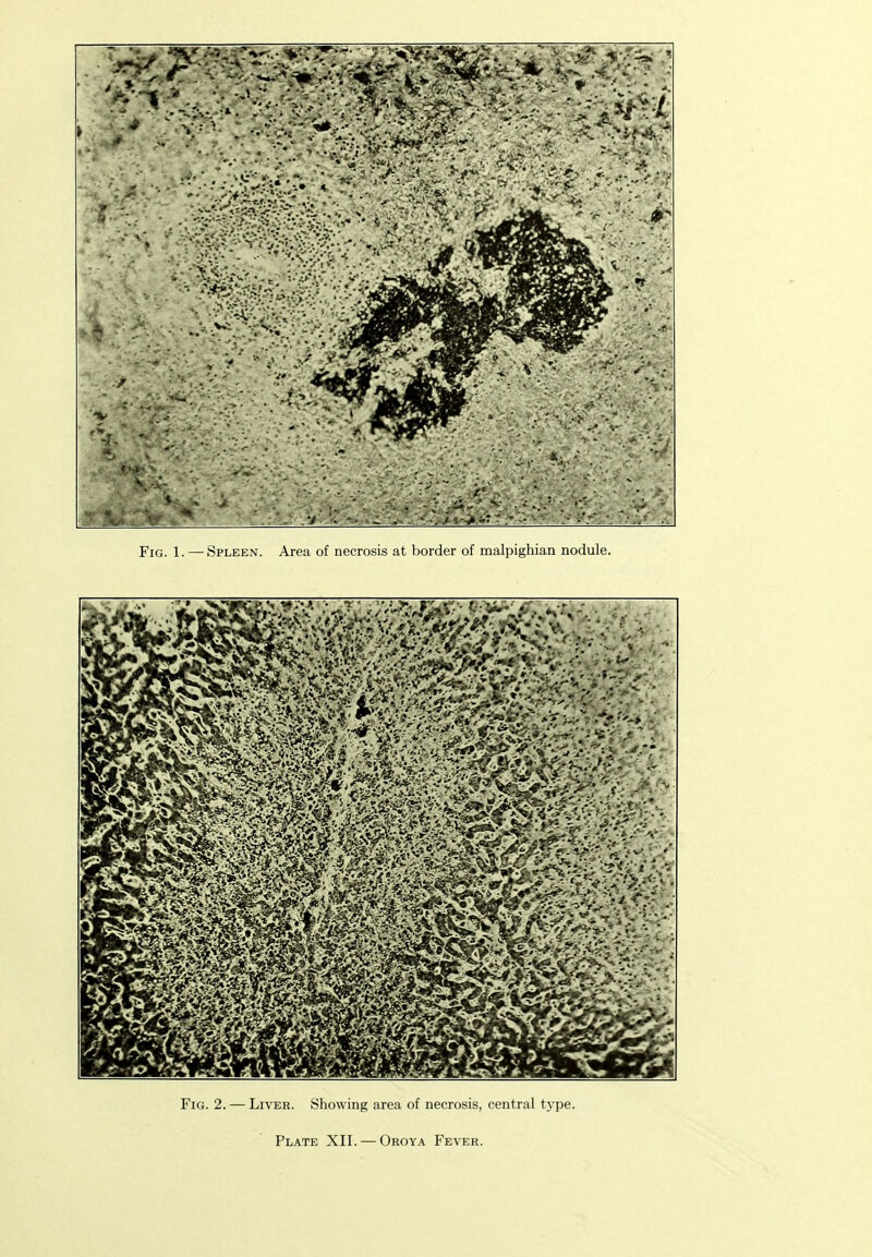 Fig. 2. — Liver. Showing area of necrosis, central type.