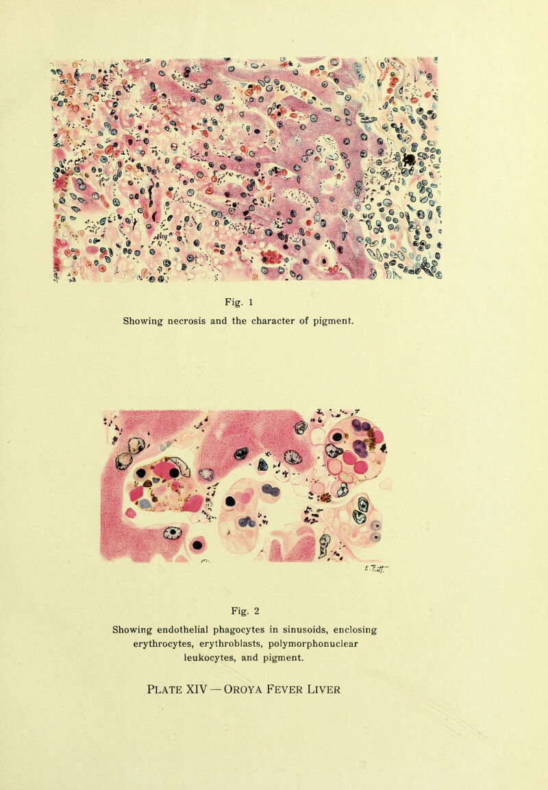 9 3 c . 9 : O 0^ 0 , • IS 6 Fig. 1 Showing necrosis and the character of pigment. Fig. 2 Showing endothelial phagocytes in sinusoids, enclosing erythrocytes, erythroblasts, polymorphonuclear leukocytes, and pigment.